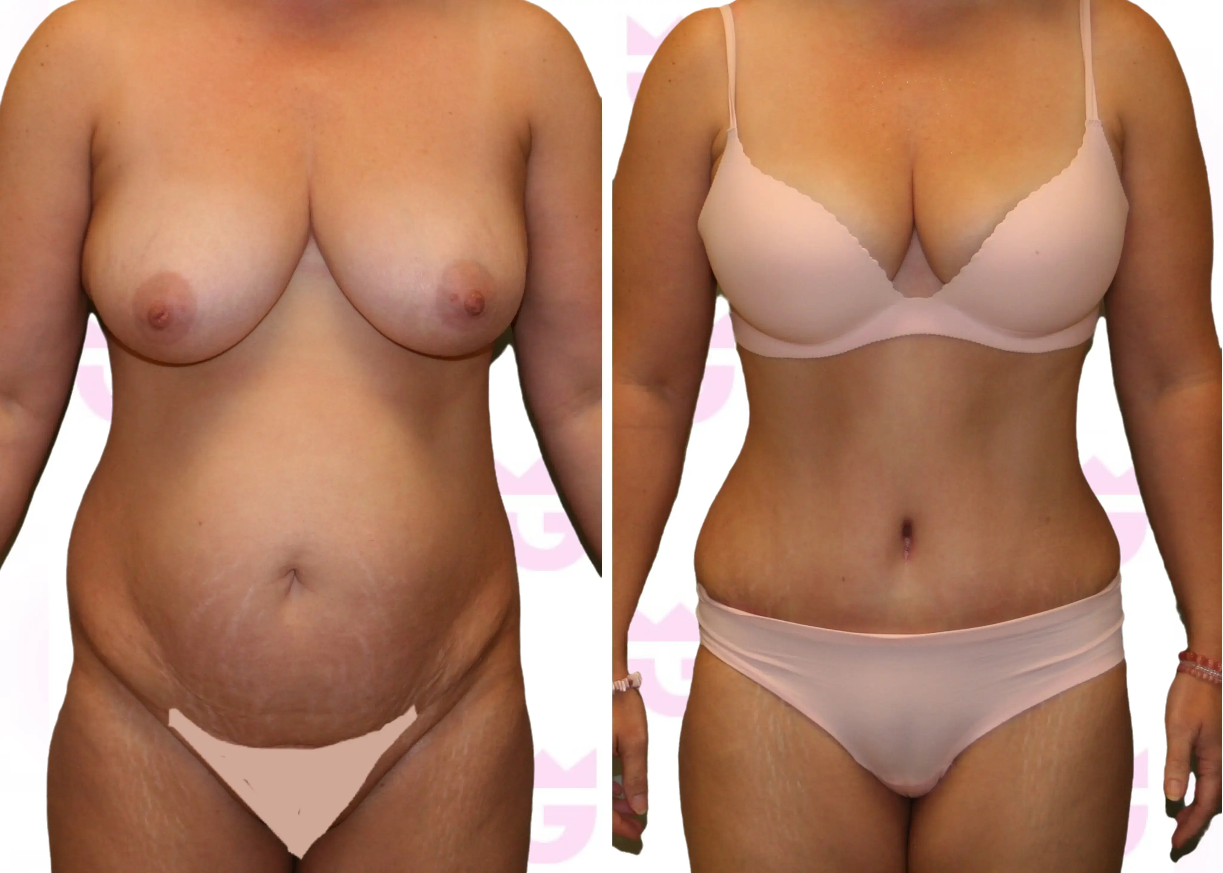 Tummy Tuck (Abdominoplasty) Gallery