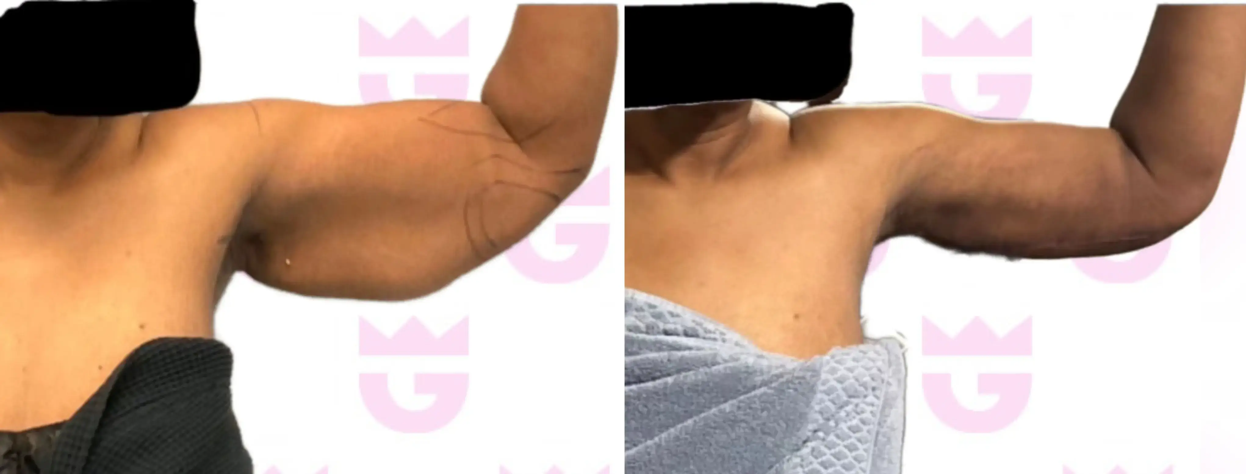 Arm Lift Gallery