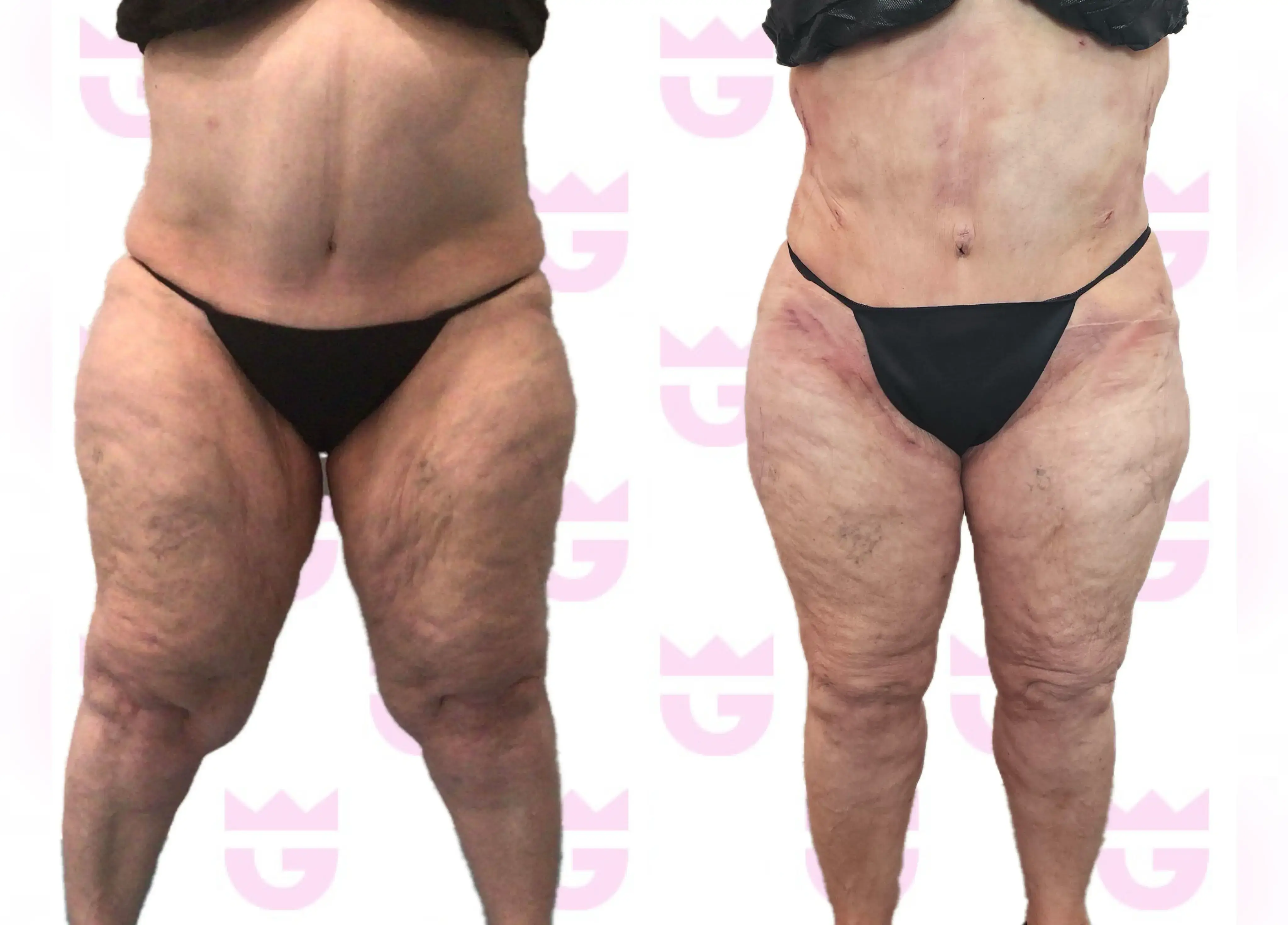 Thigh Lift Gallery