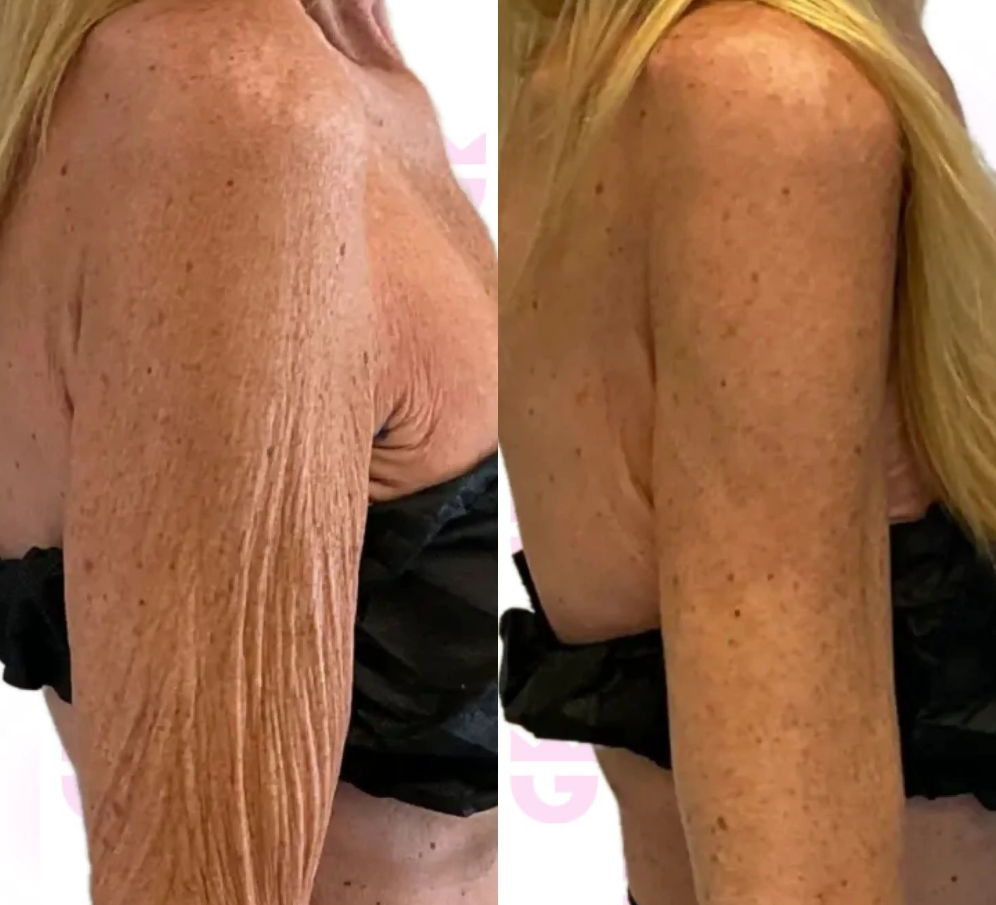 Arm Lift Gallery