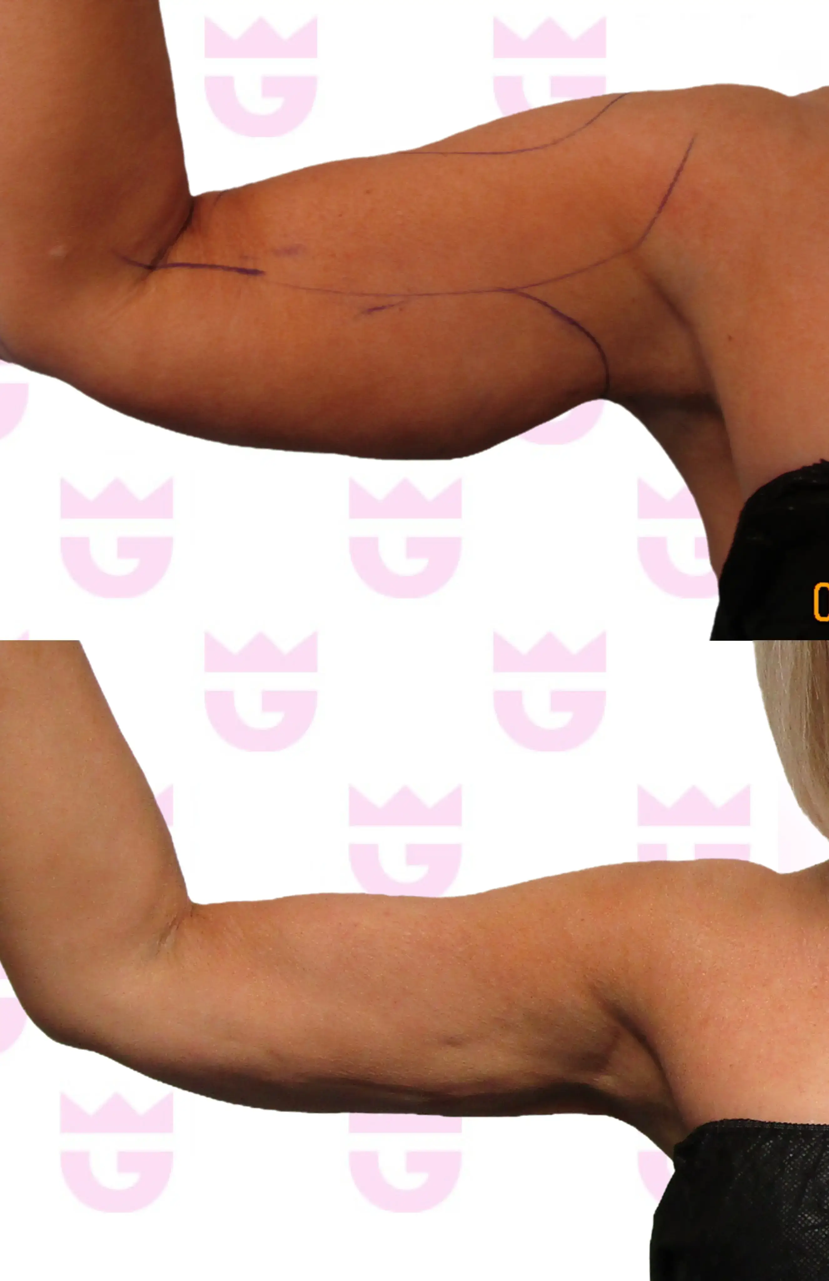 Arm Lift Gallery