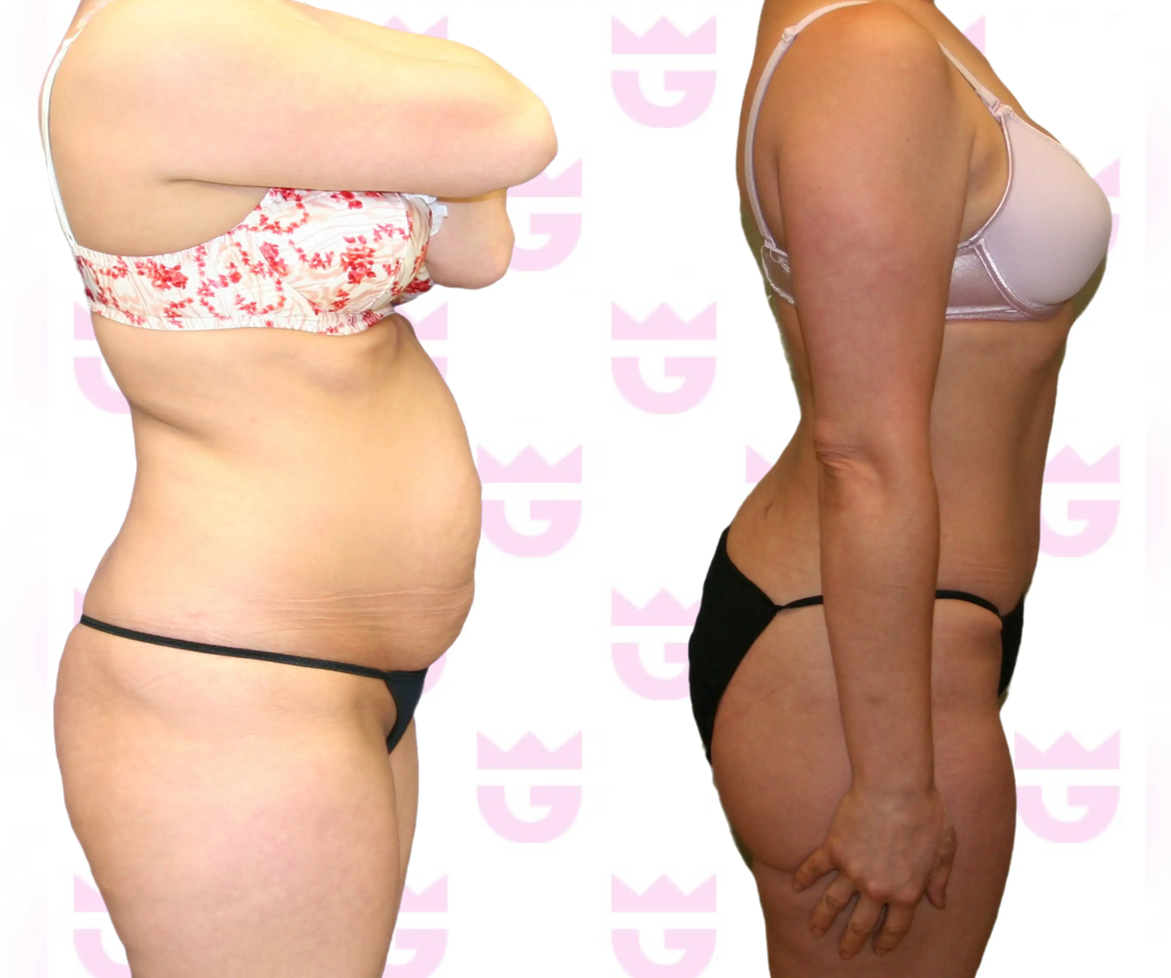 Tummy Tuck (Abdominoplasty) Gallery