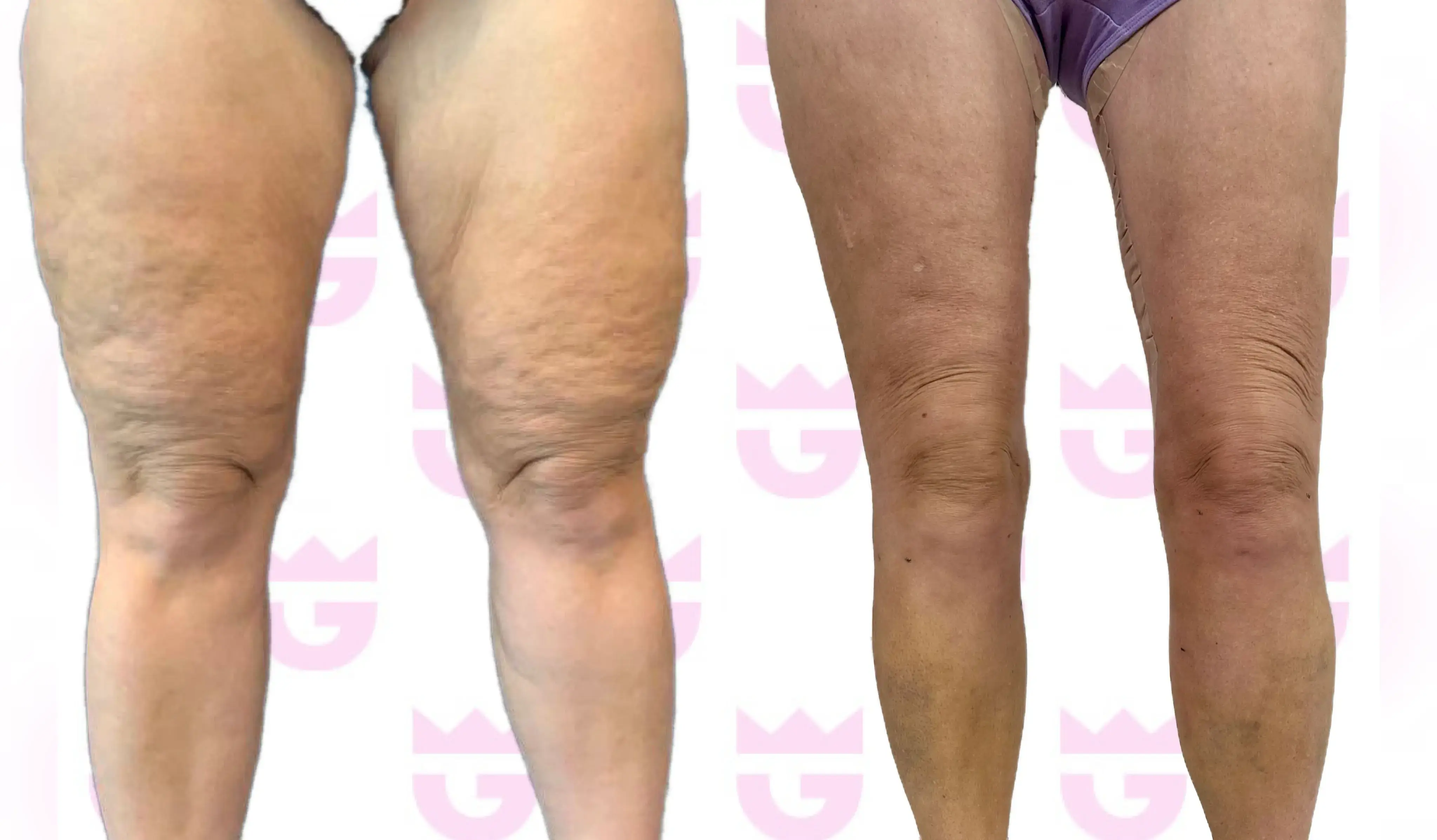 Thigh Lift Gallery