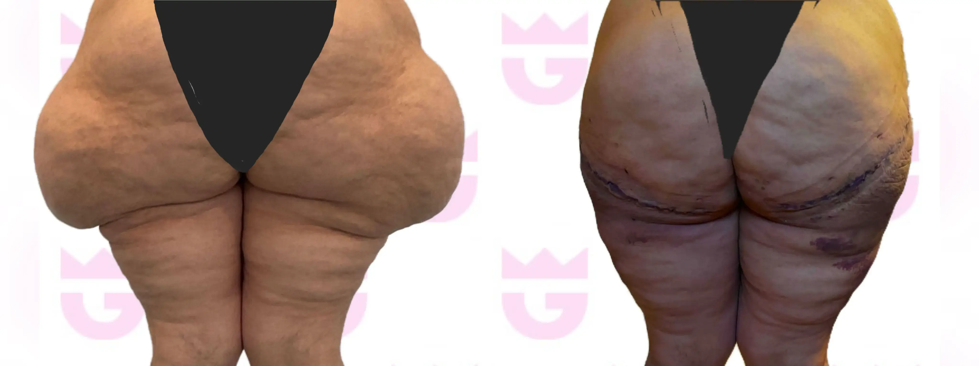 Thigh Lift Gallery