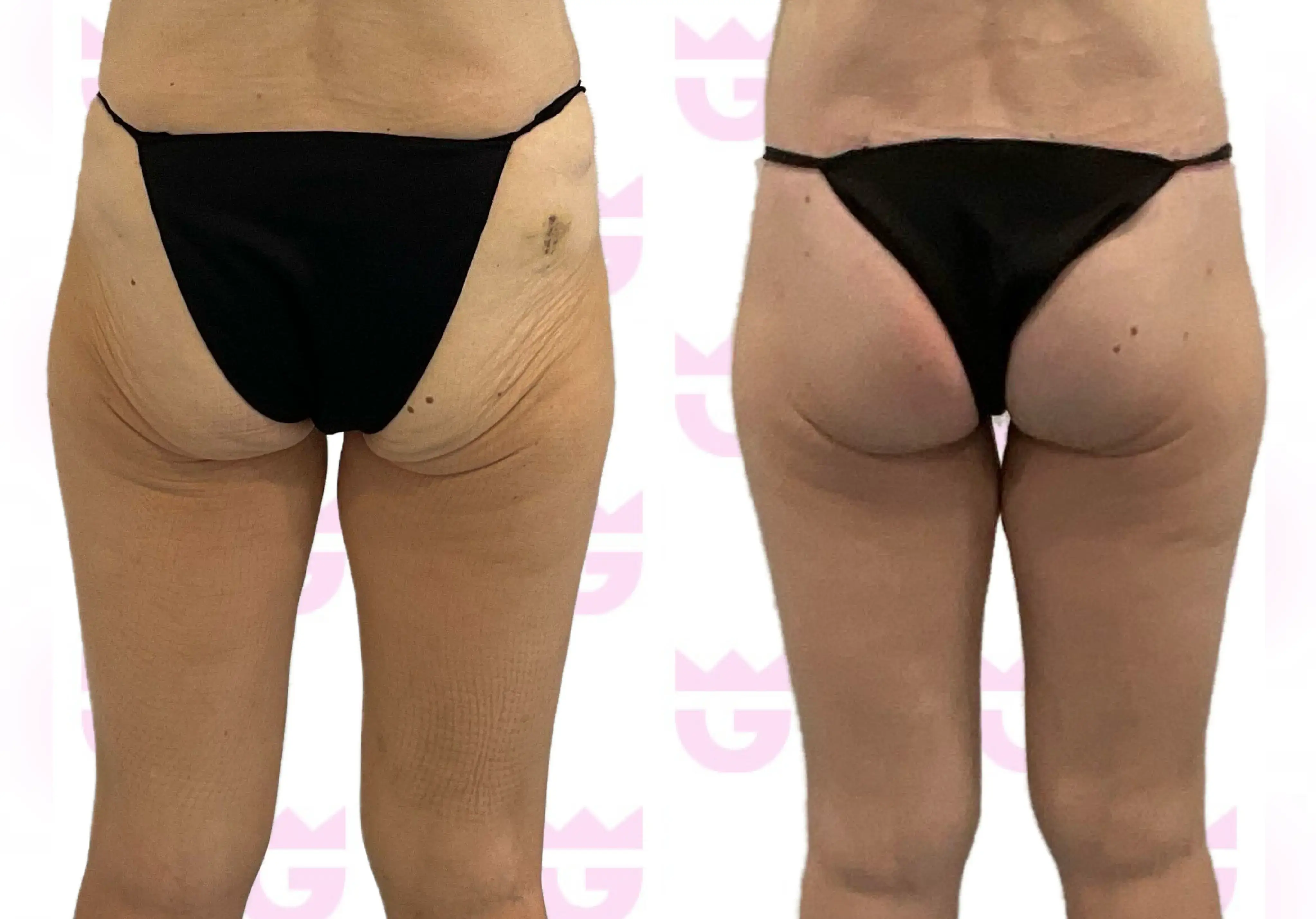 Buttock Lift Gallery