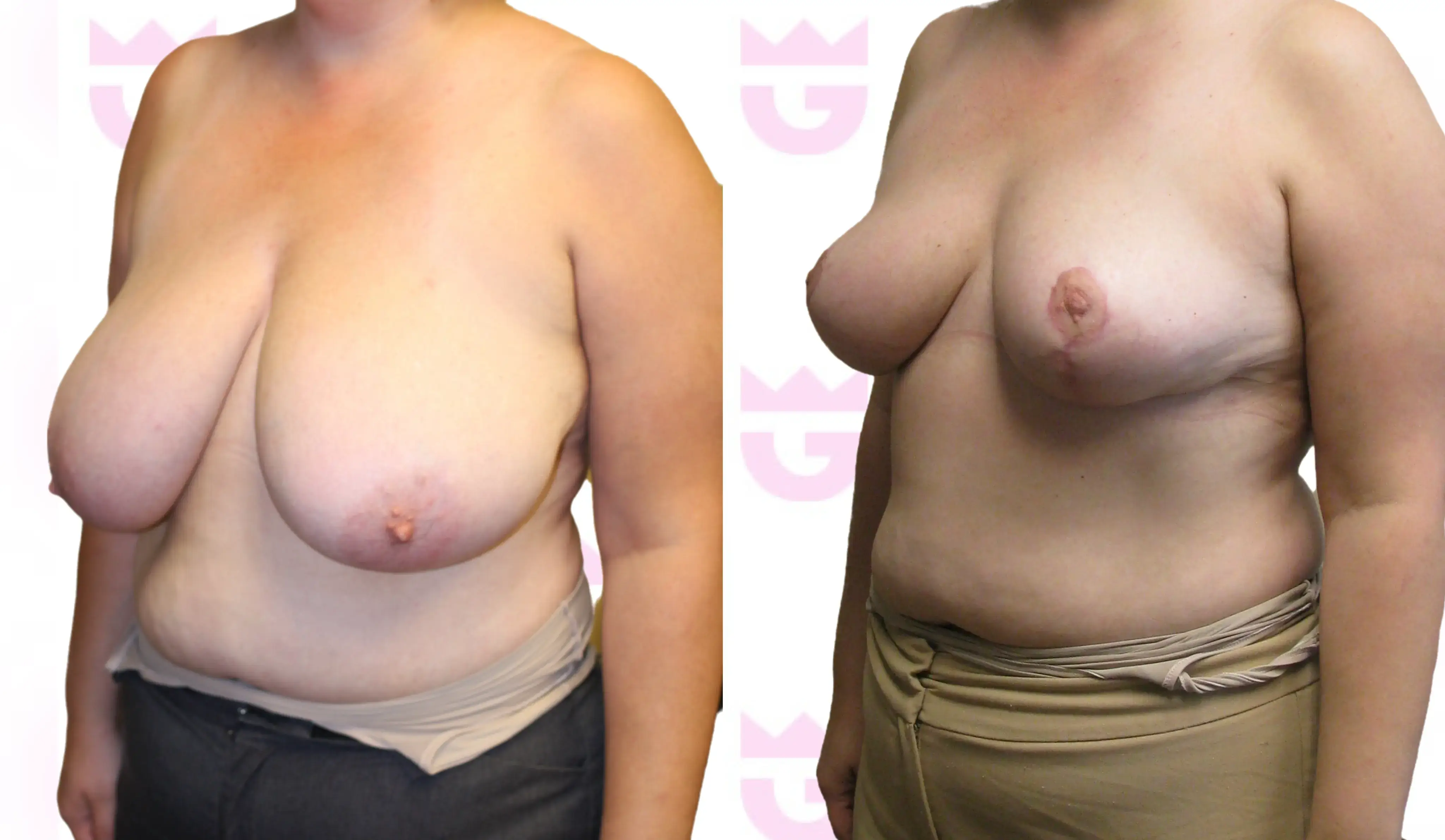 Breast Reduction Gallery