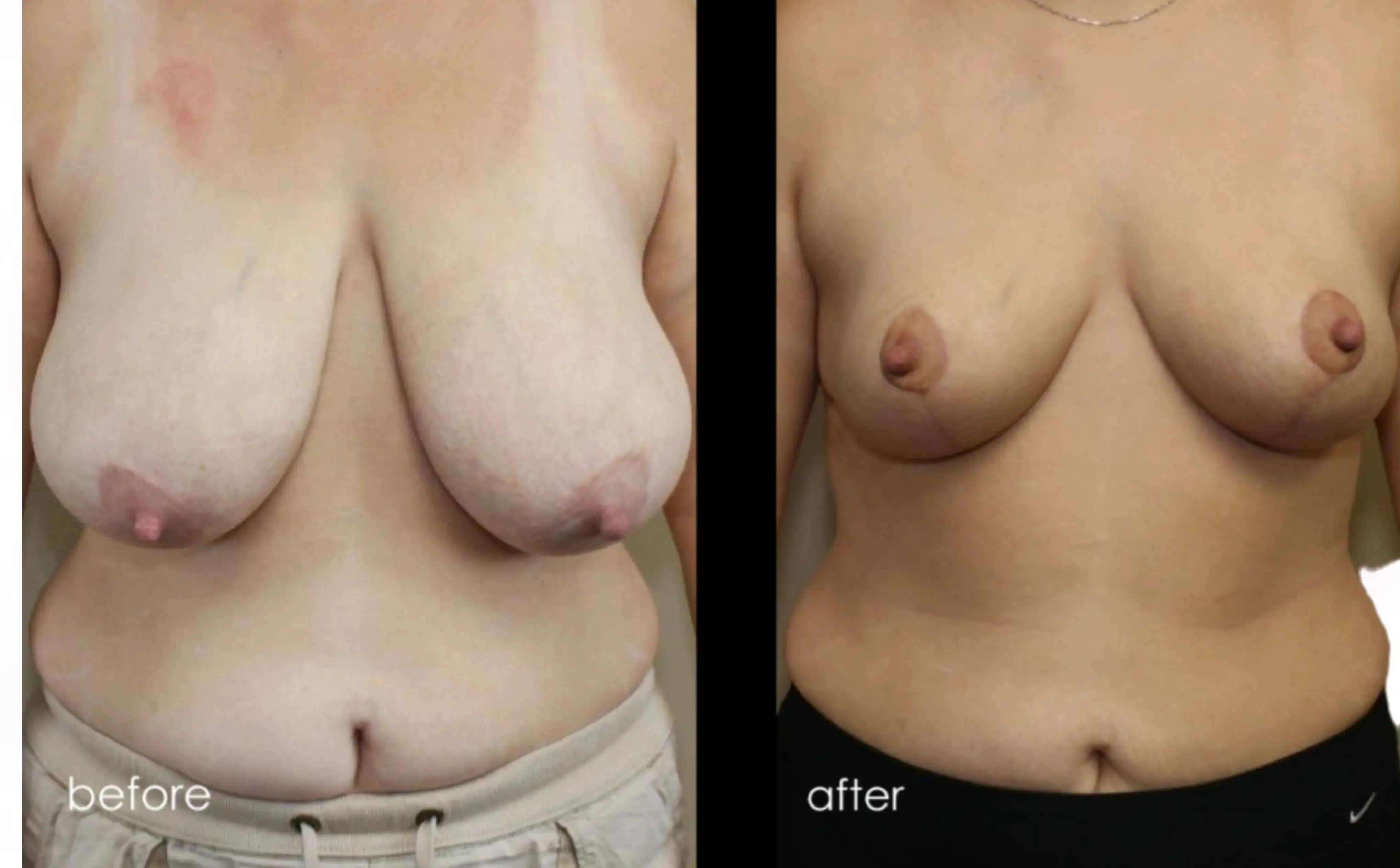 Breast Reduction Gallery