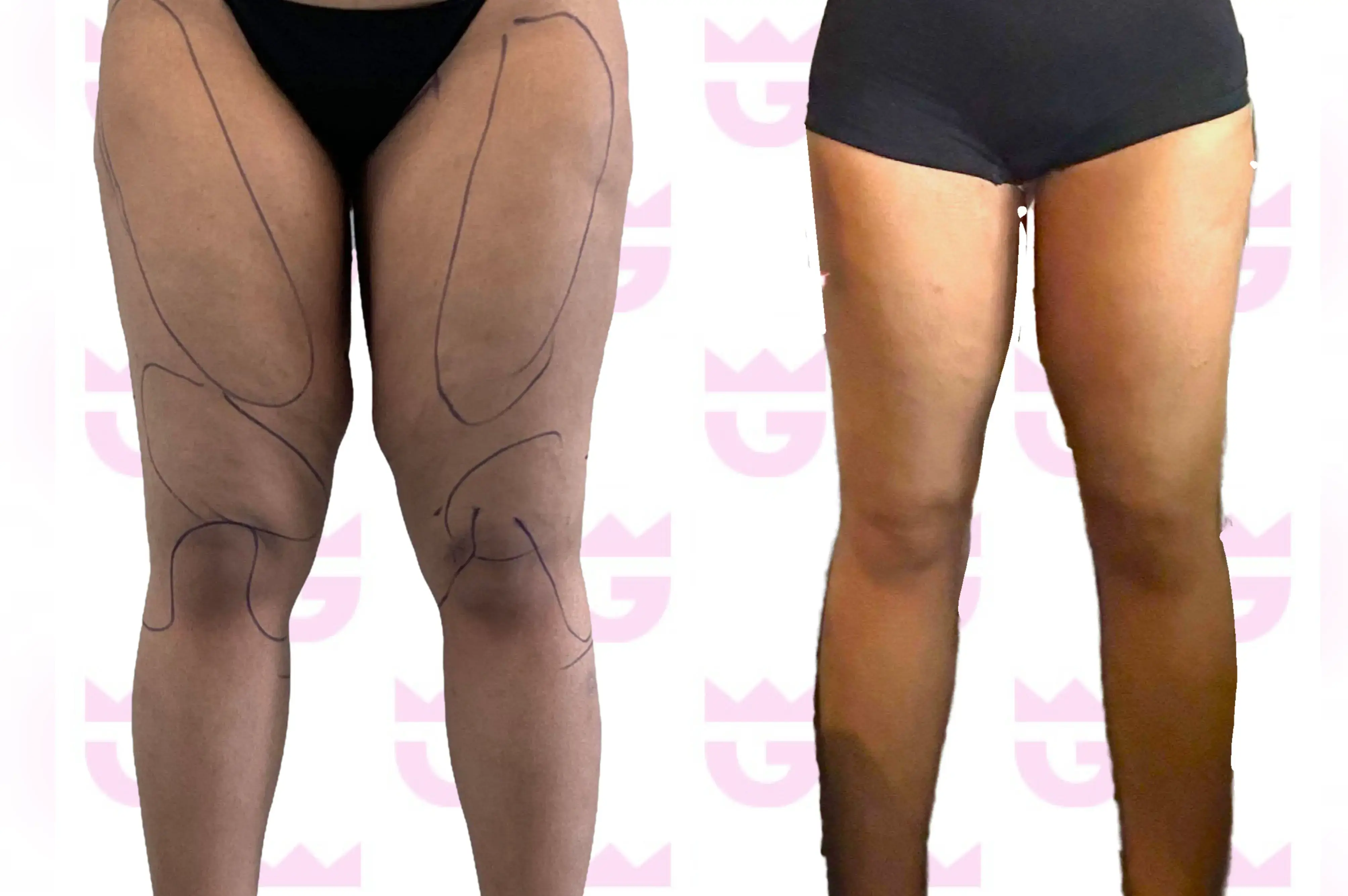 Thigh Lift Gallery