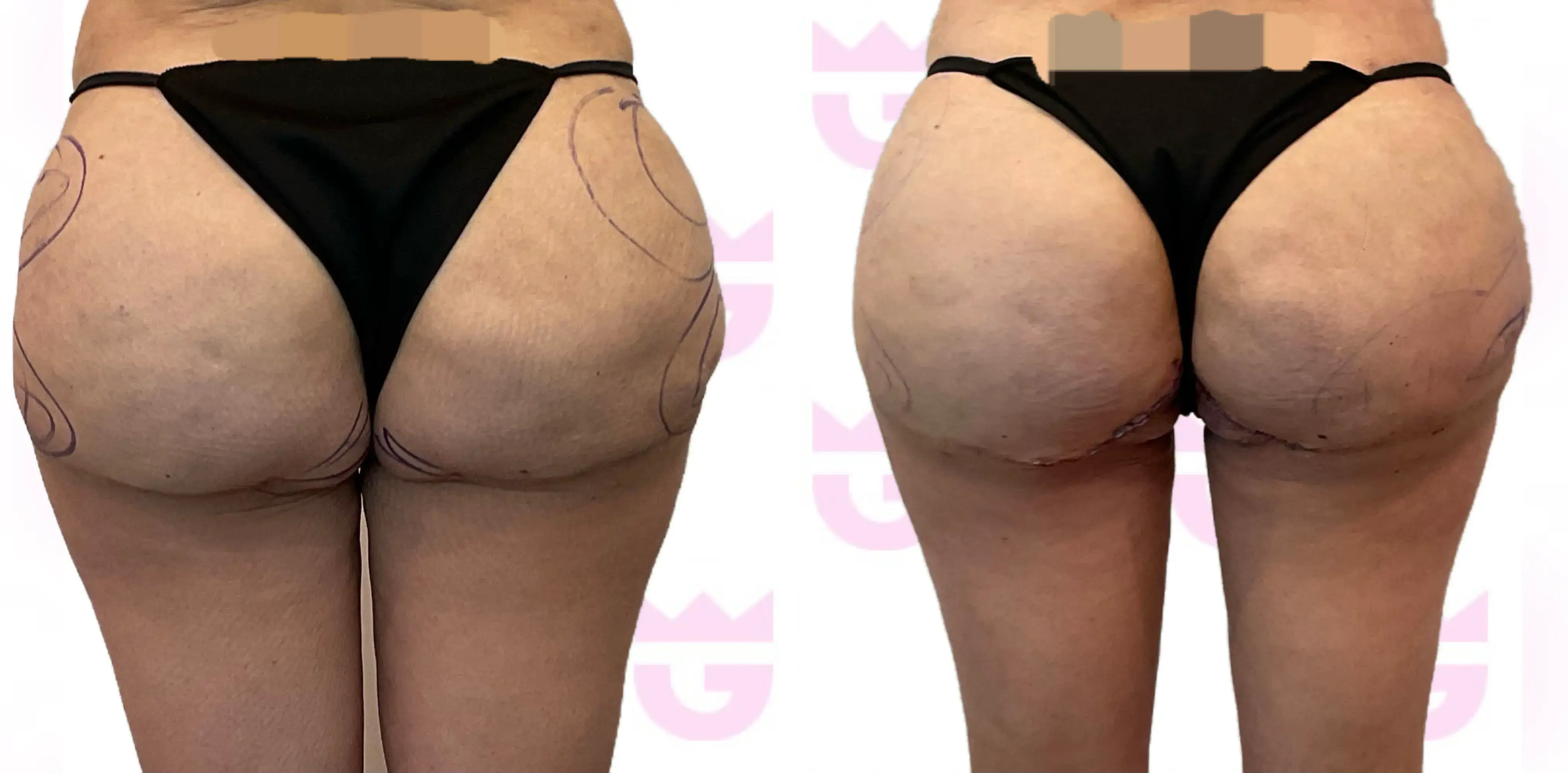 Thigh Lift Gallery