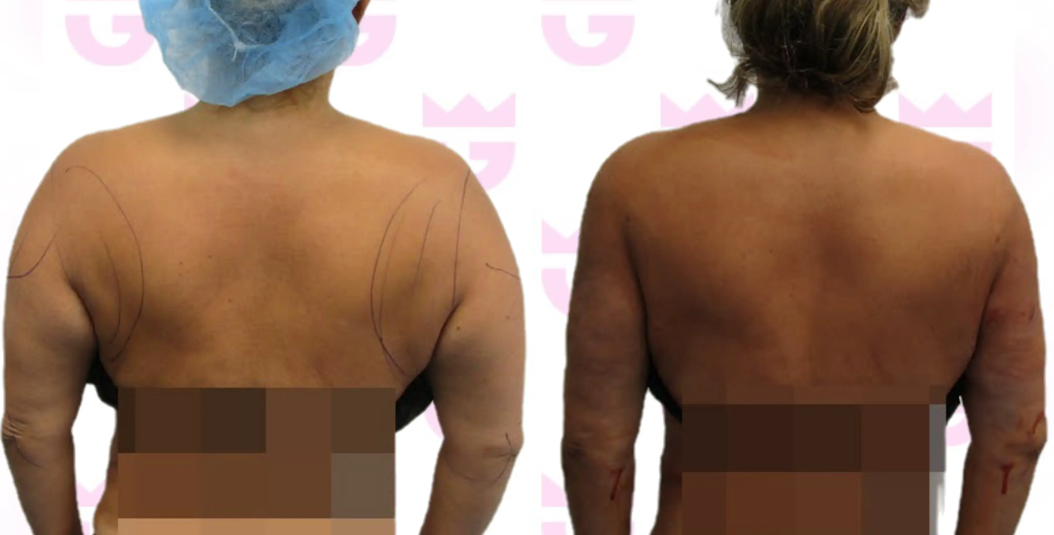 Back Liposuction Gallery