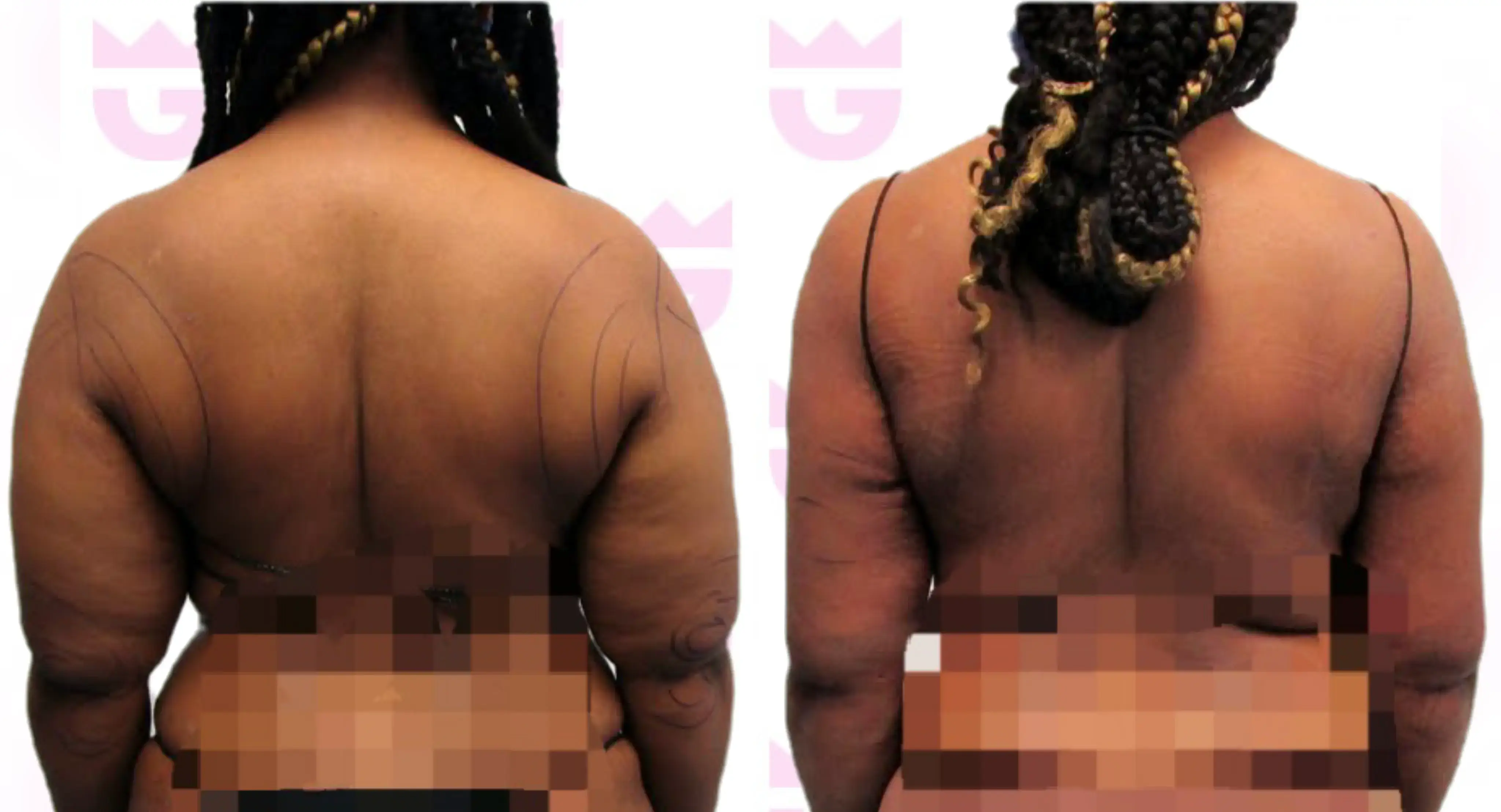 Back Liposuction Gallery