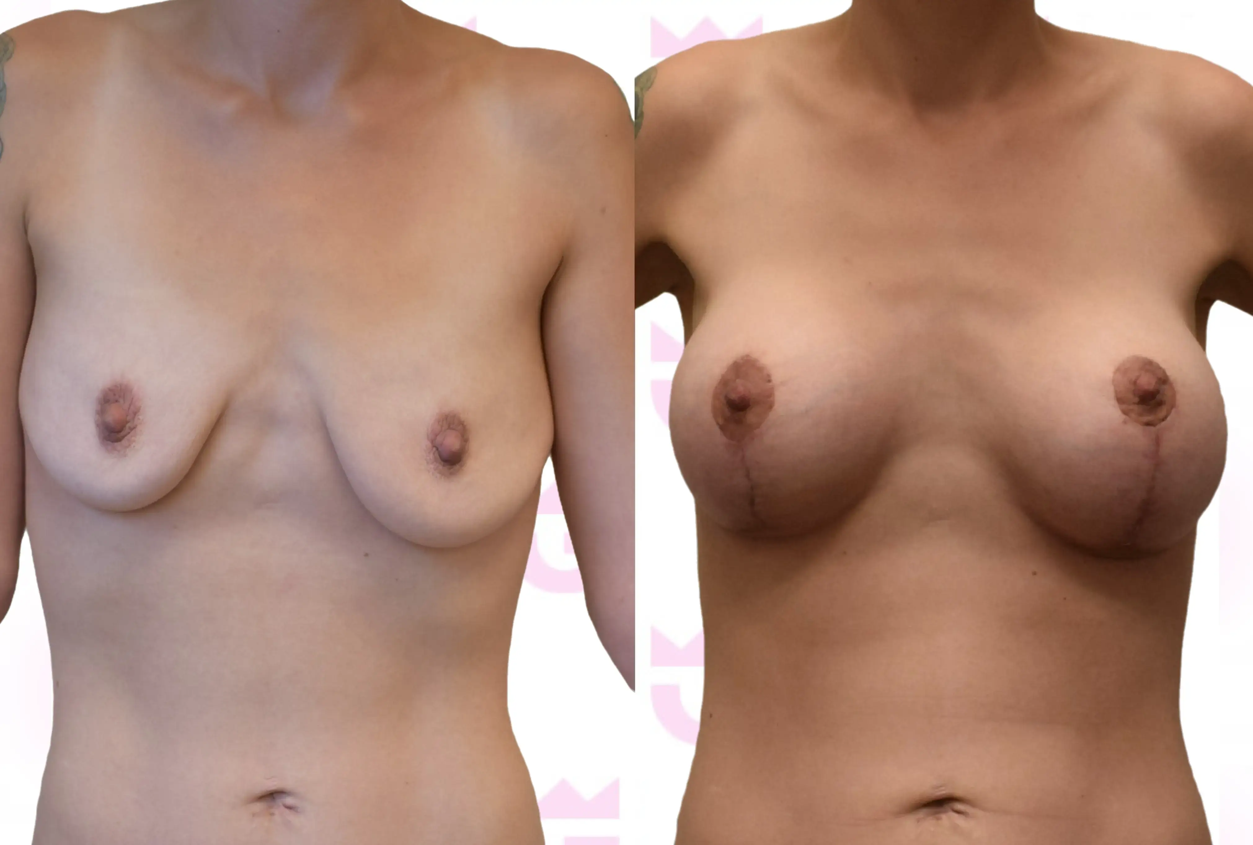 Breast Lift Gallery