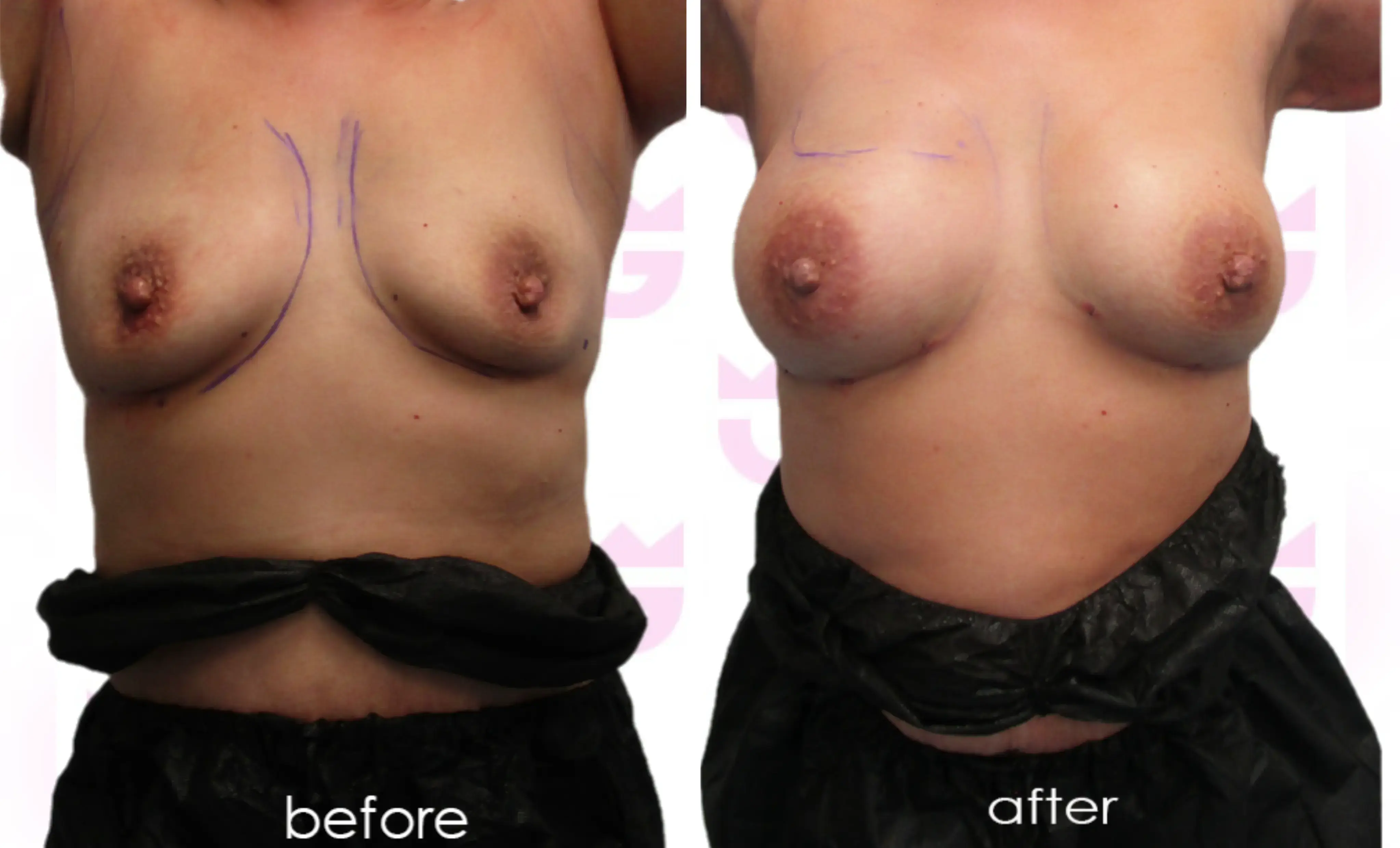 Breast Fat Transfer Gallery