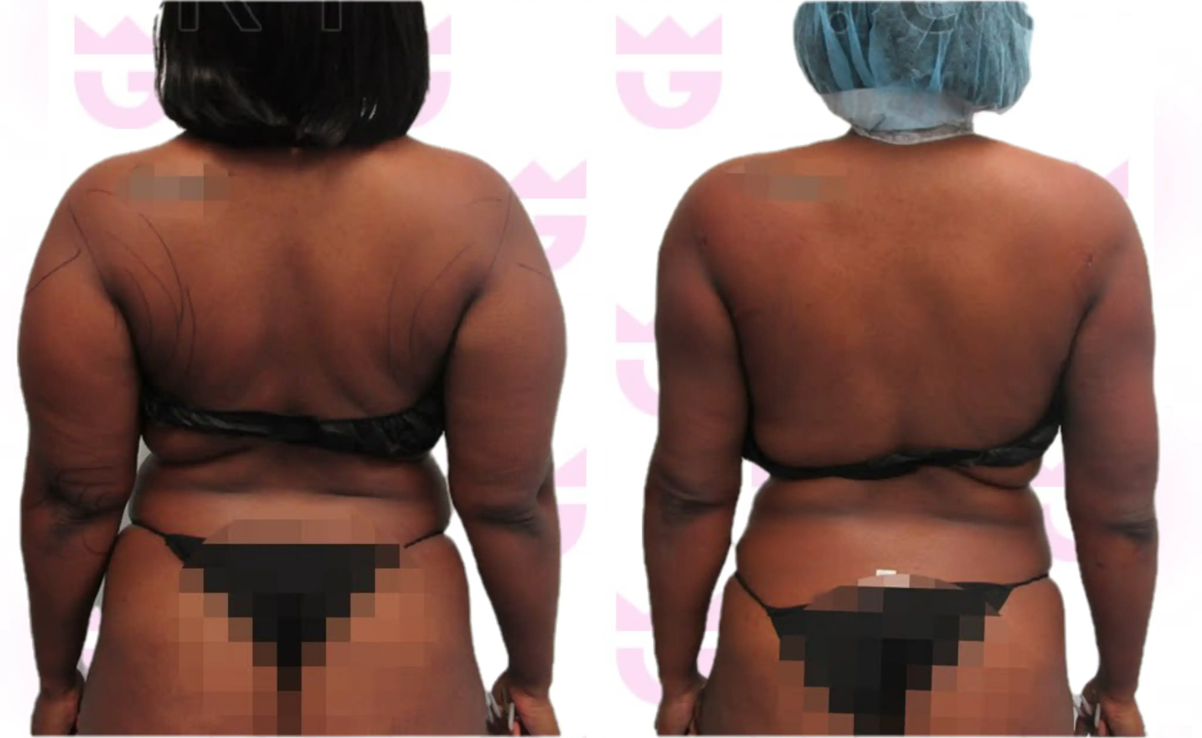 Back Liposuction Gallery