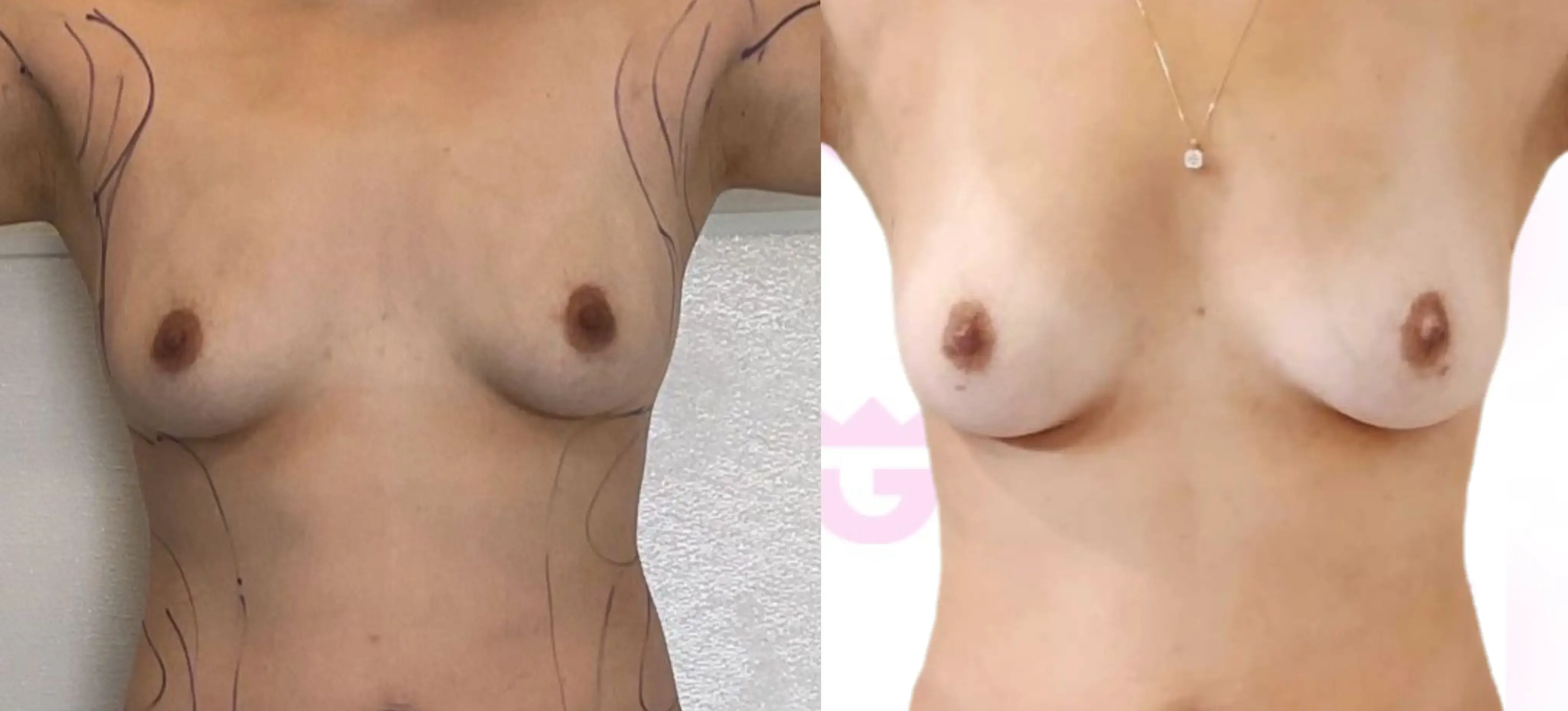 Breast Fat Transfer Gallery