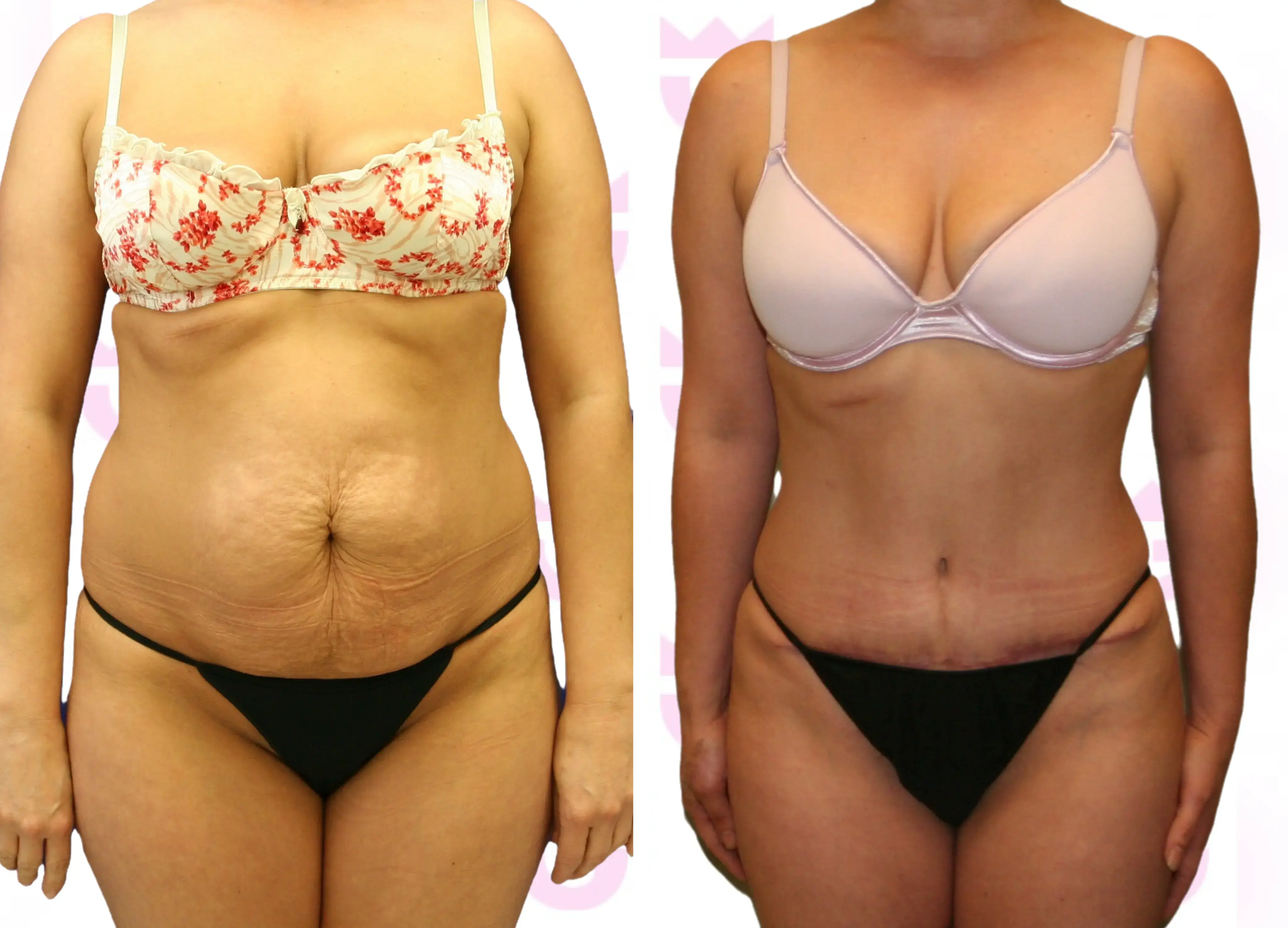 Tummy Tuck (Abdominoplasty) Gallery