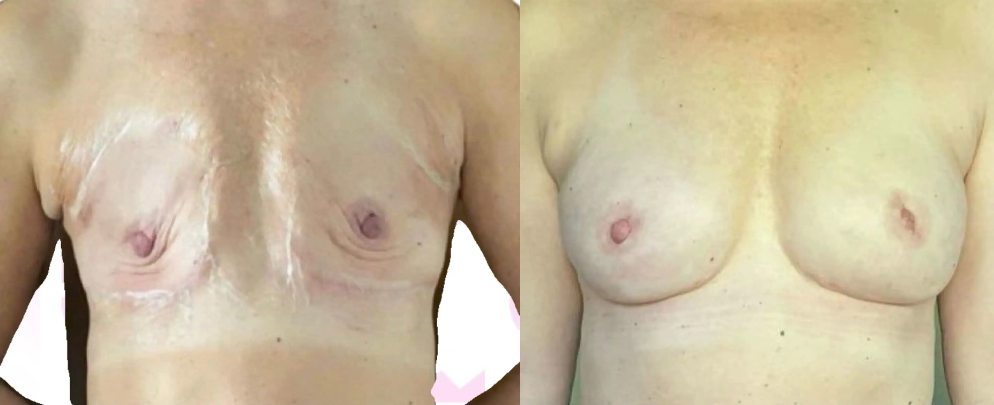Breast Fat Transfer Gallery
