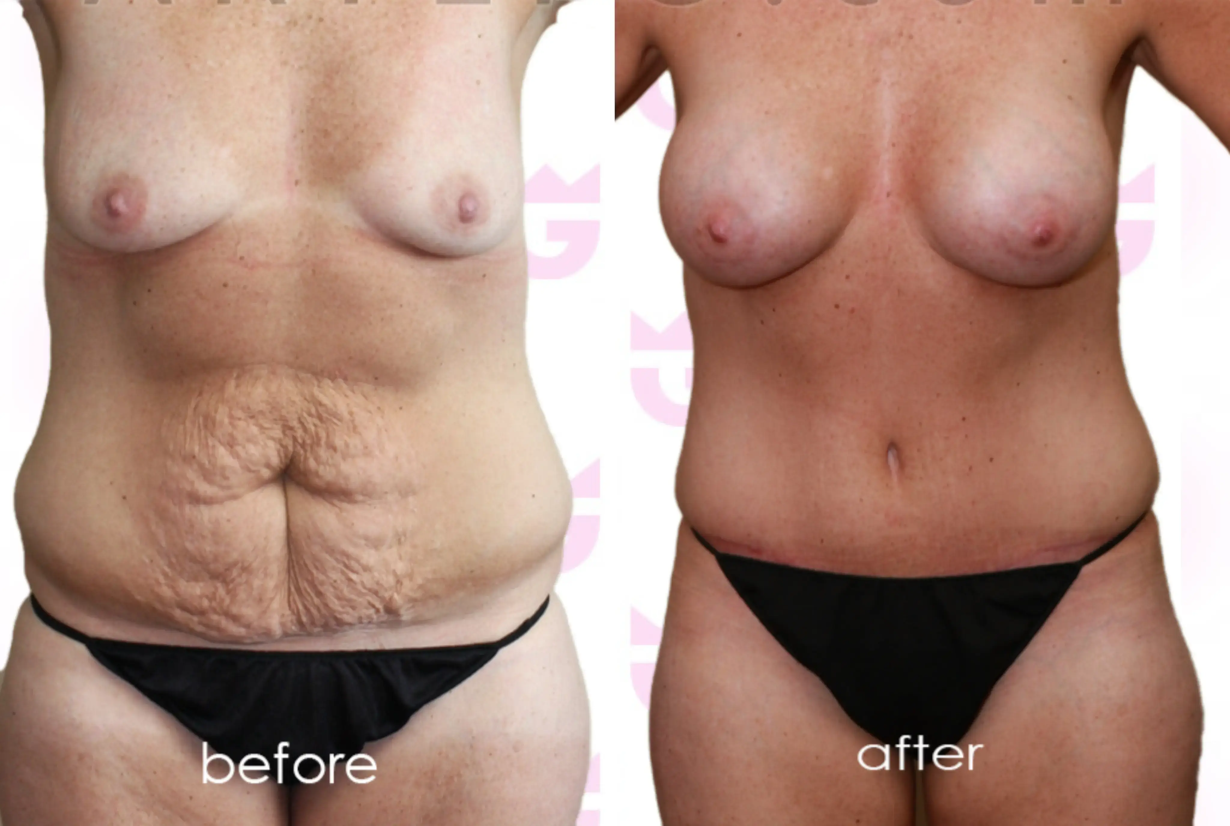 Tummy Tuck (Abdominoplasty) Gallery