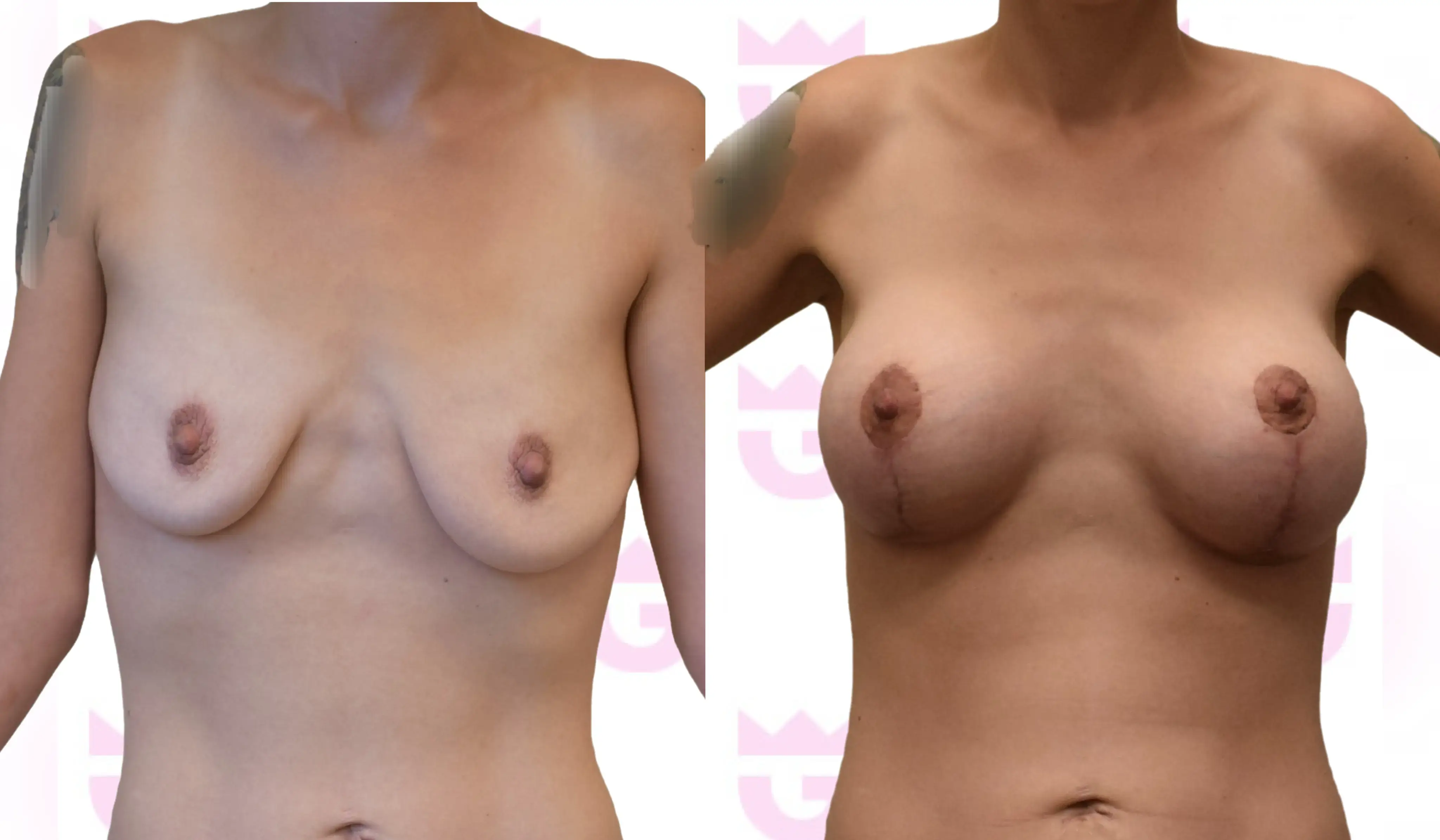 Breast Augmentation Gallery