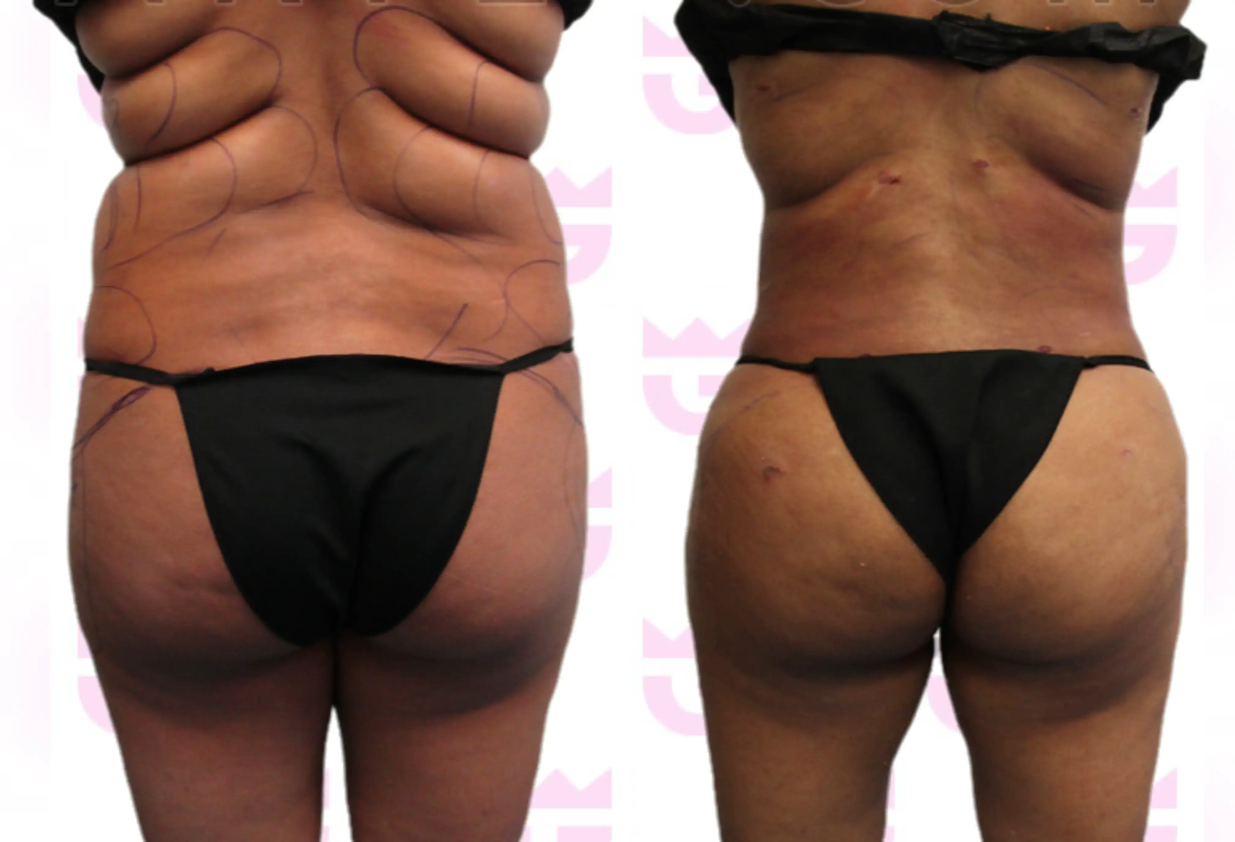 Back Liposuction Gallery
