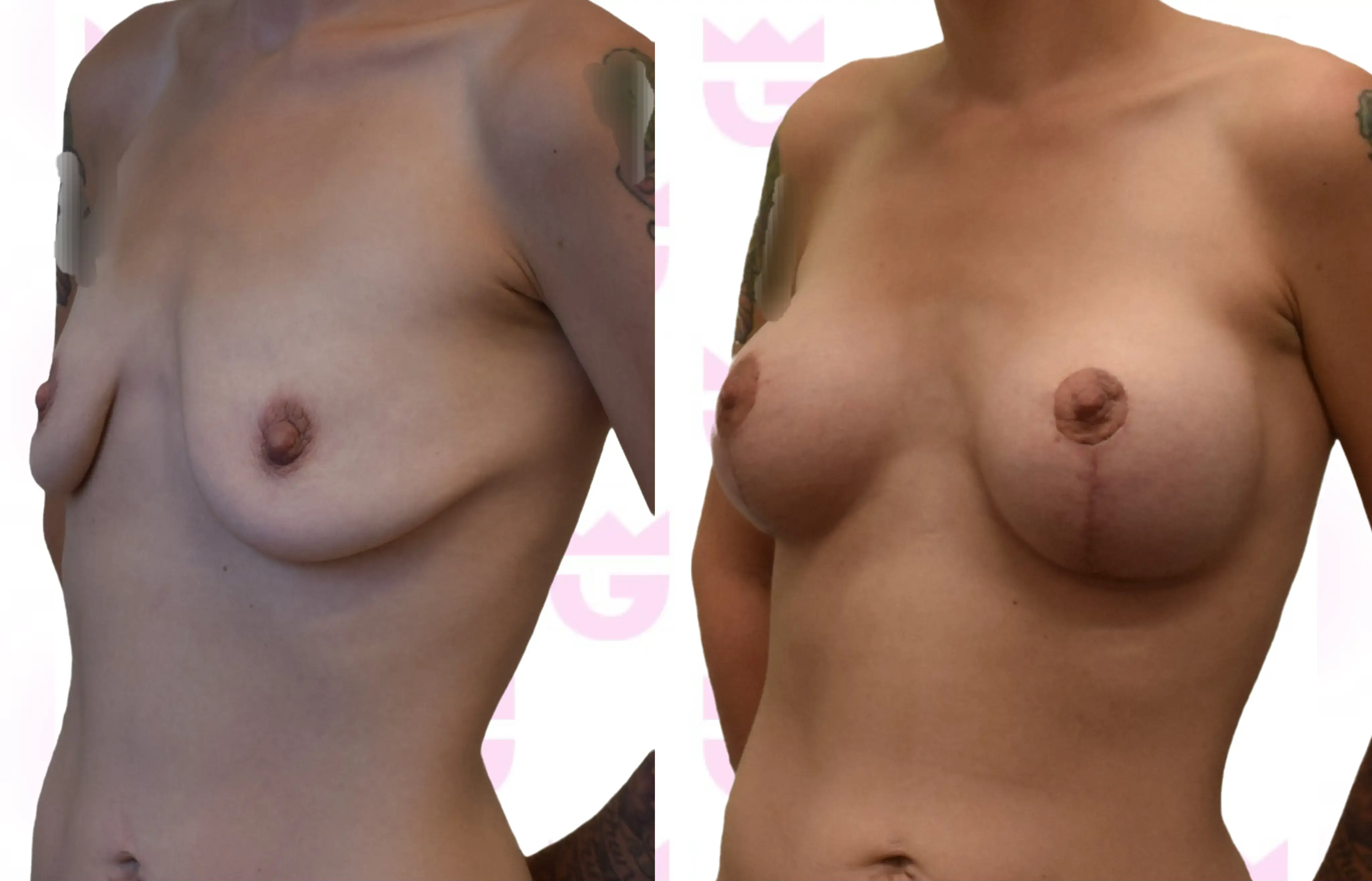 Breast Augmentation Gallery