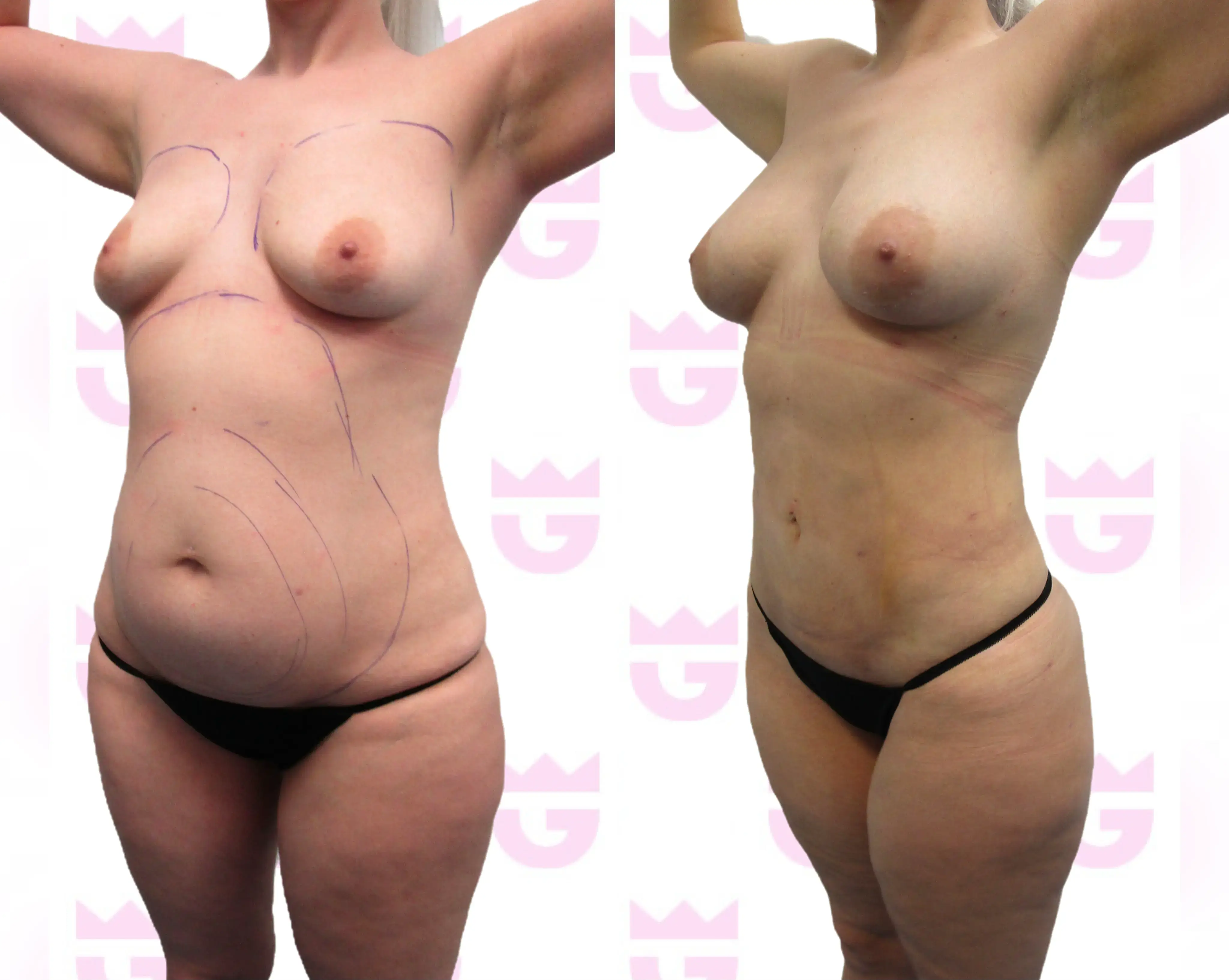 Abdomen Liposuction Gallery