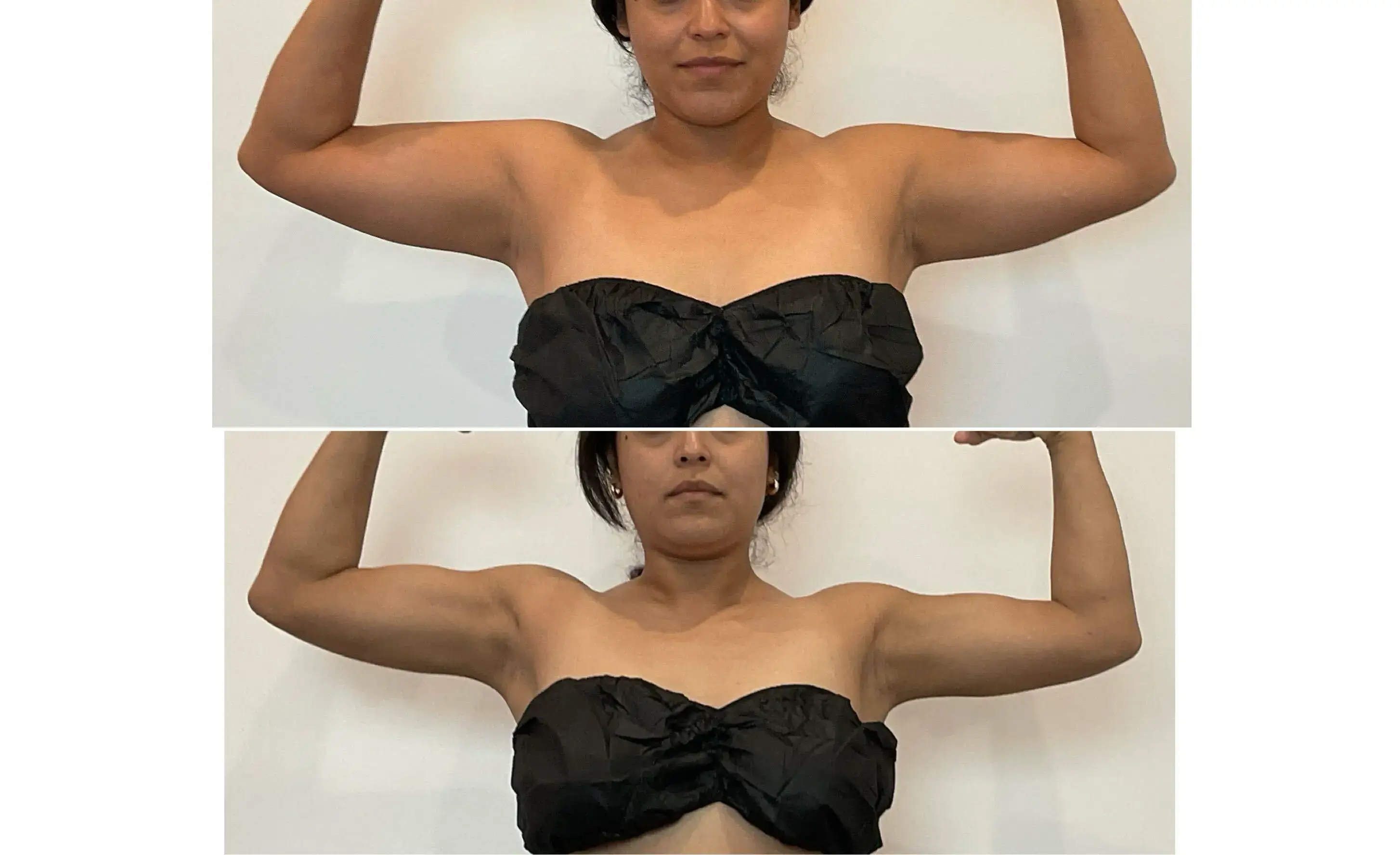 Armpit Liposuction Gallery