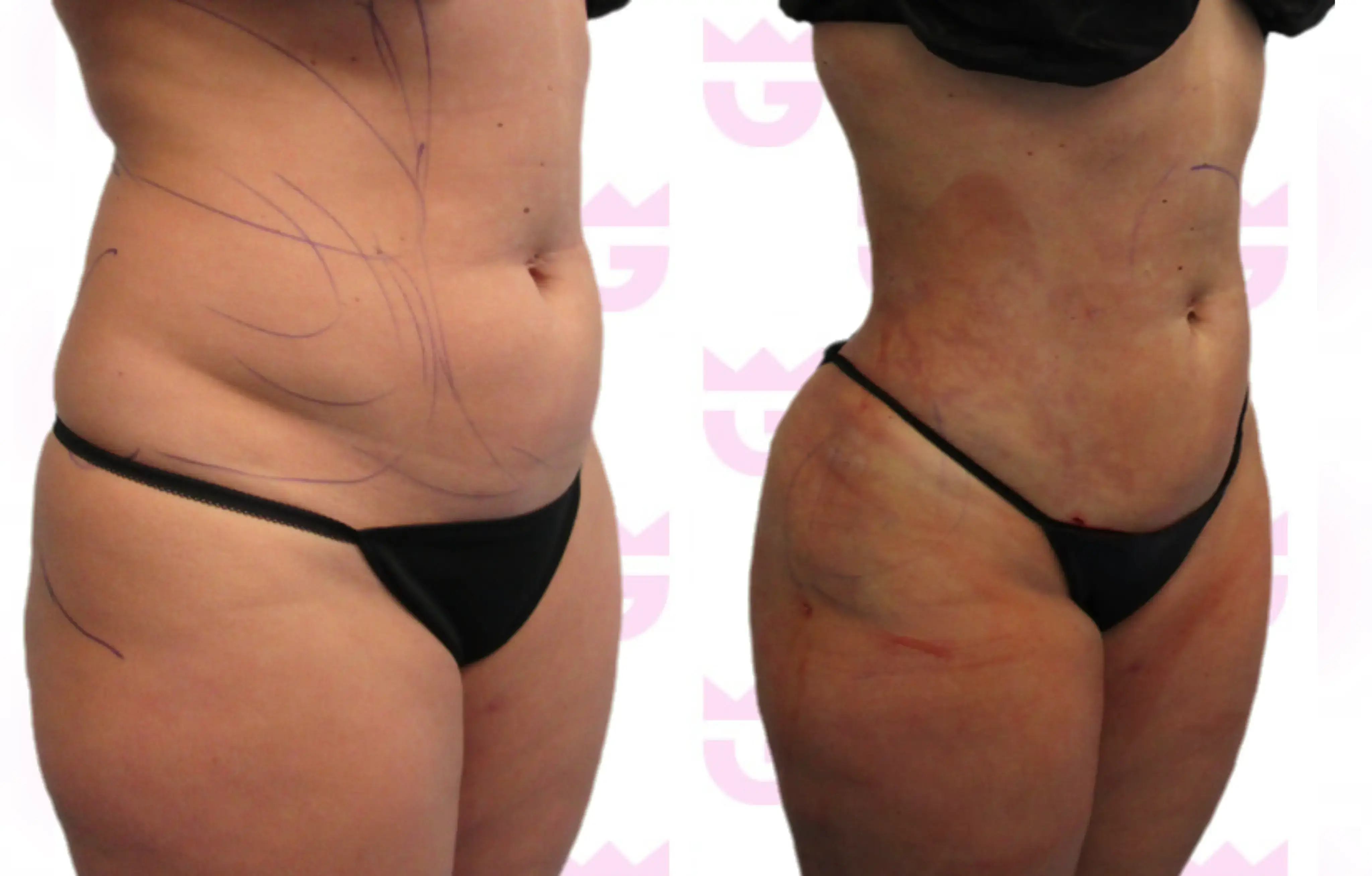 Abdomen Liposuction Gallery