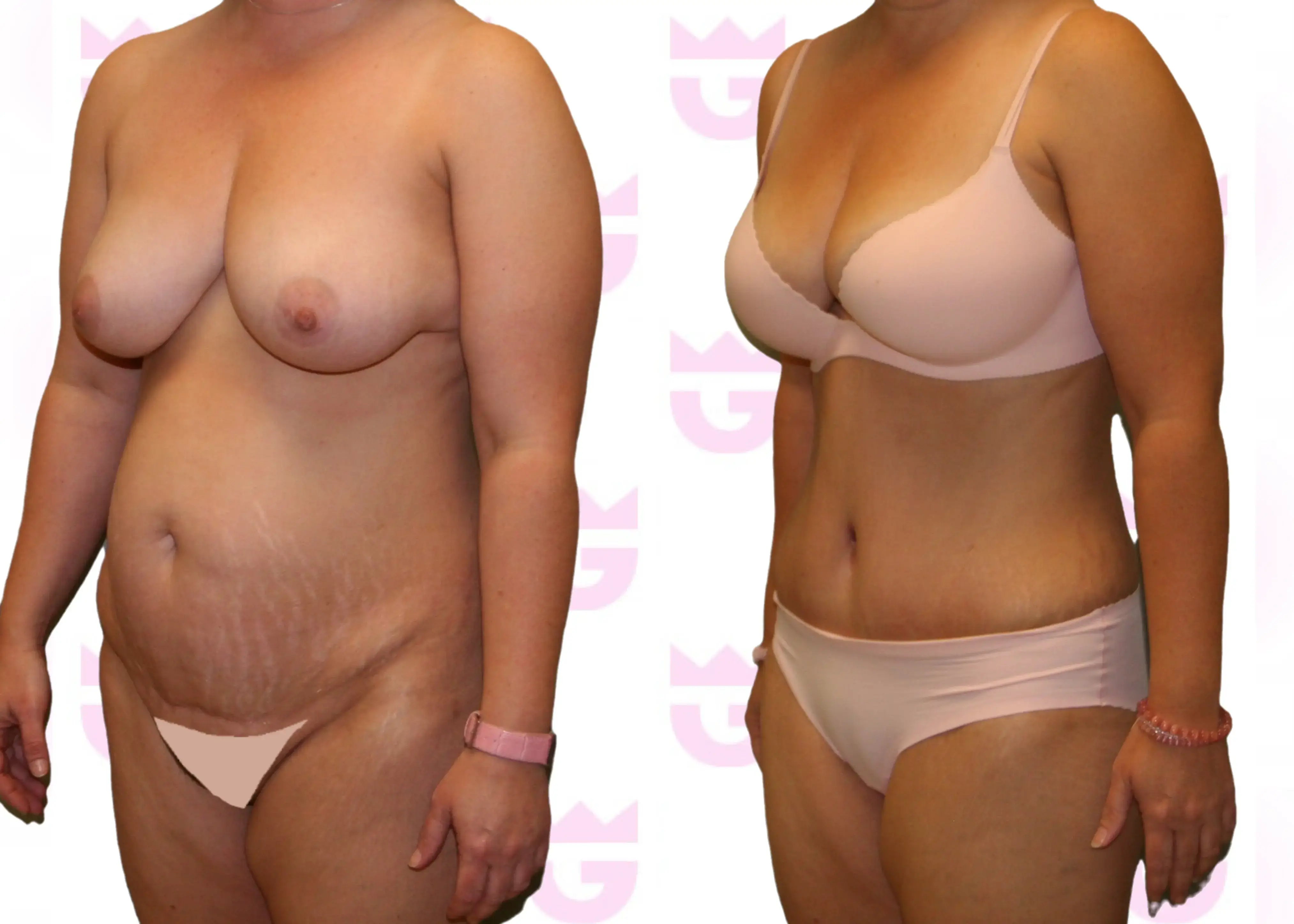 Tummy Tuck (Abdominoplasty) Gallery
