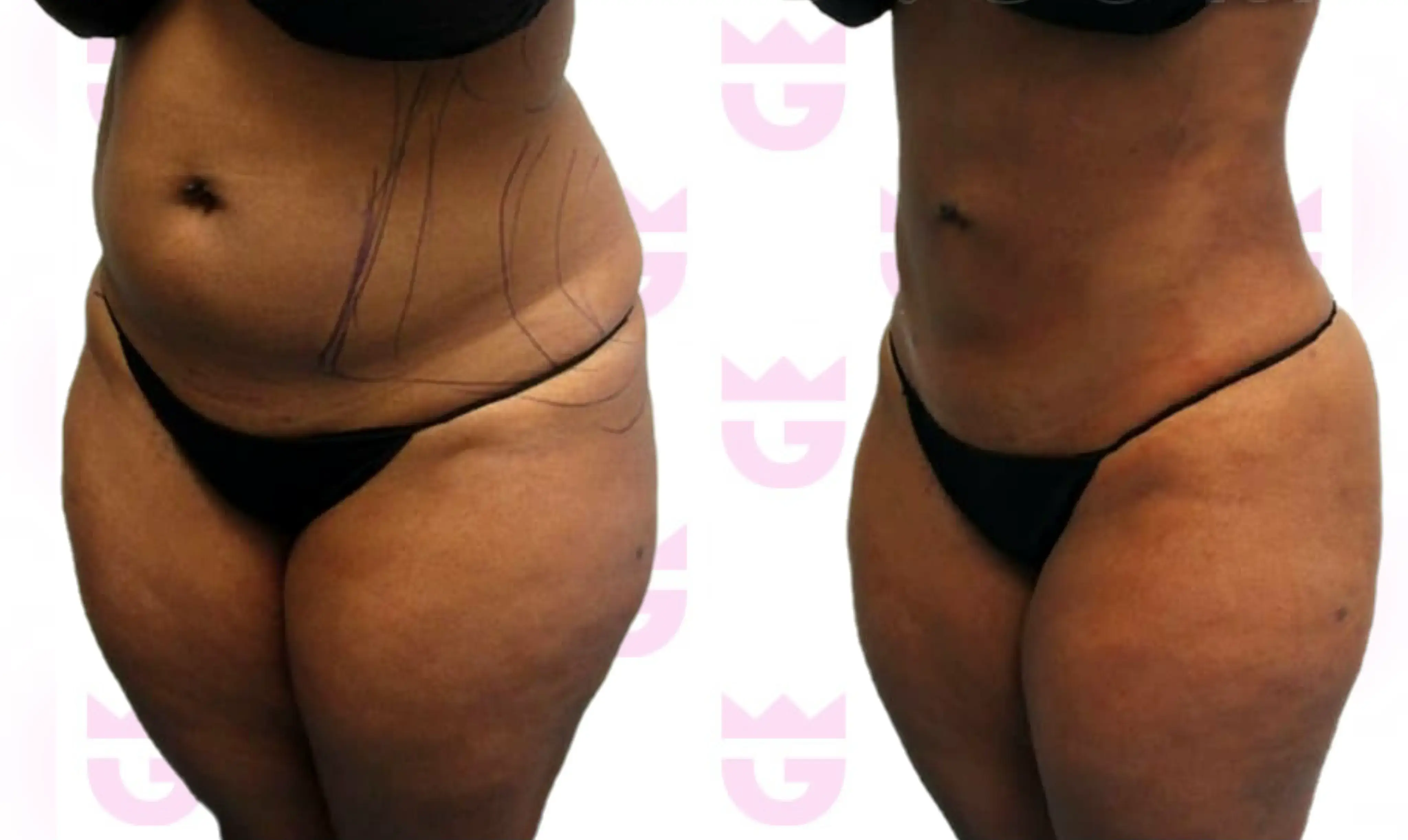 Abdomen Liposuction Gallery