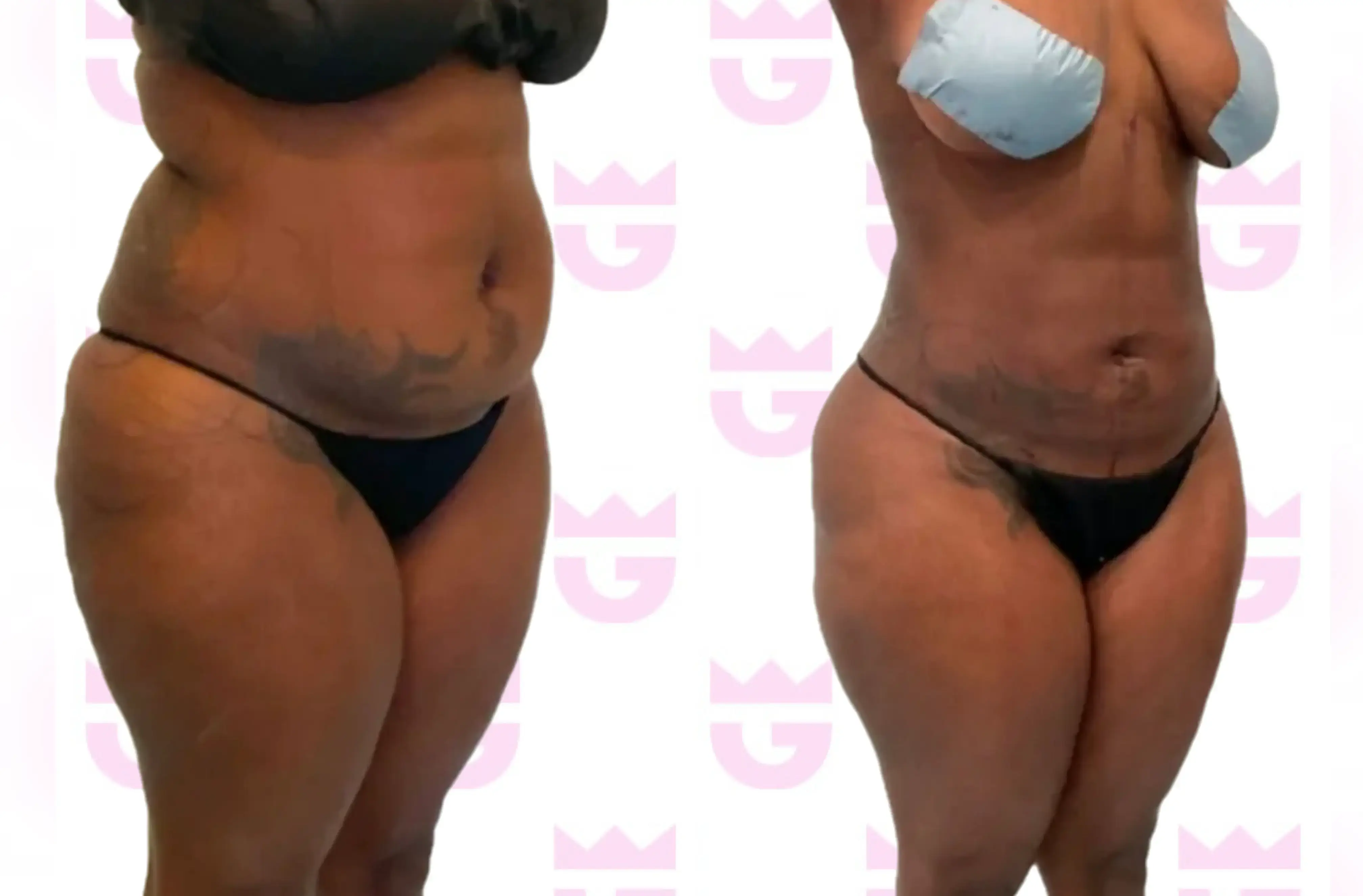 Abdomen Liposuction Gallery