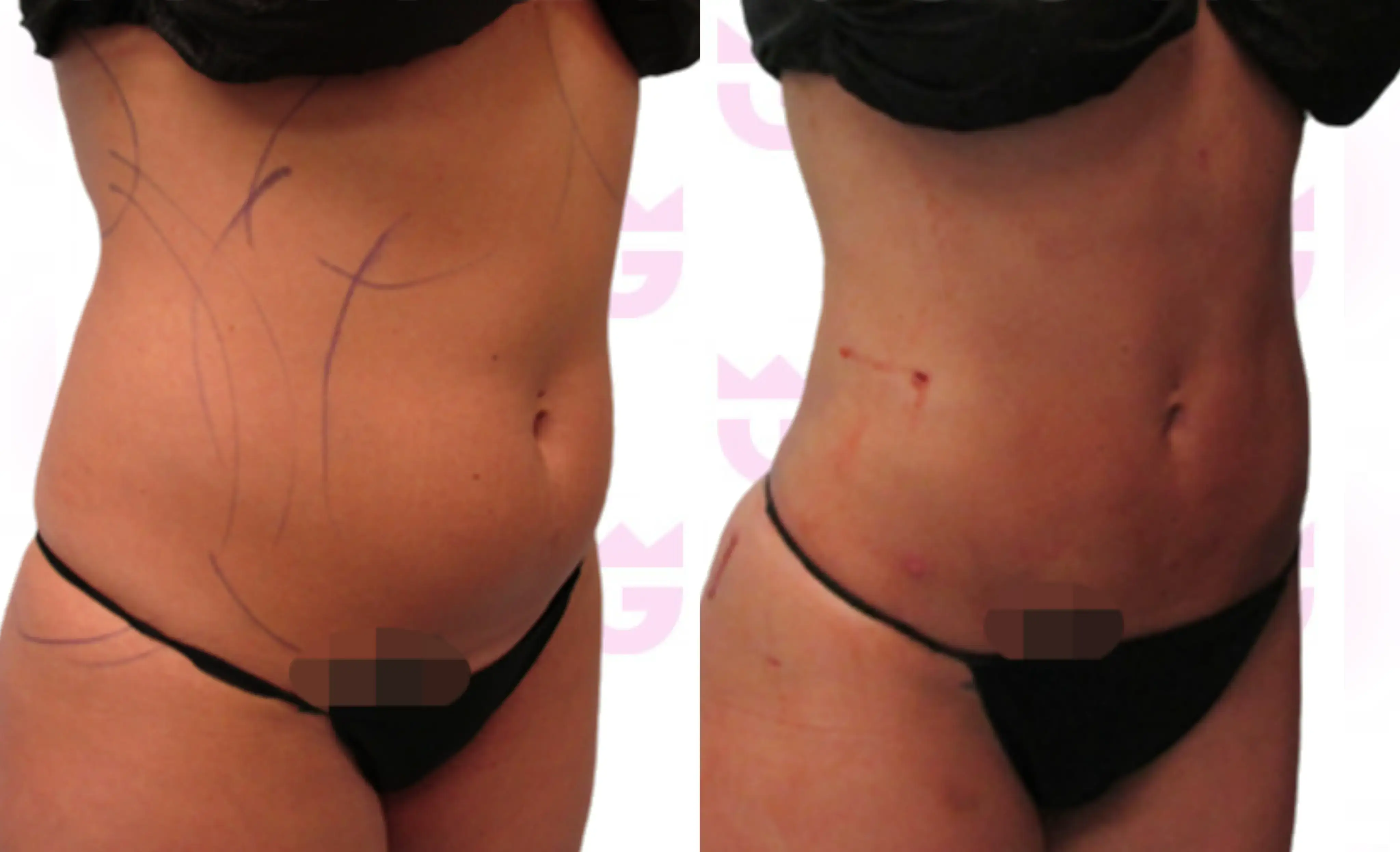 Abdomen Liposuction Gallery