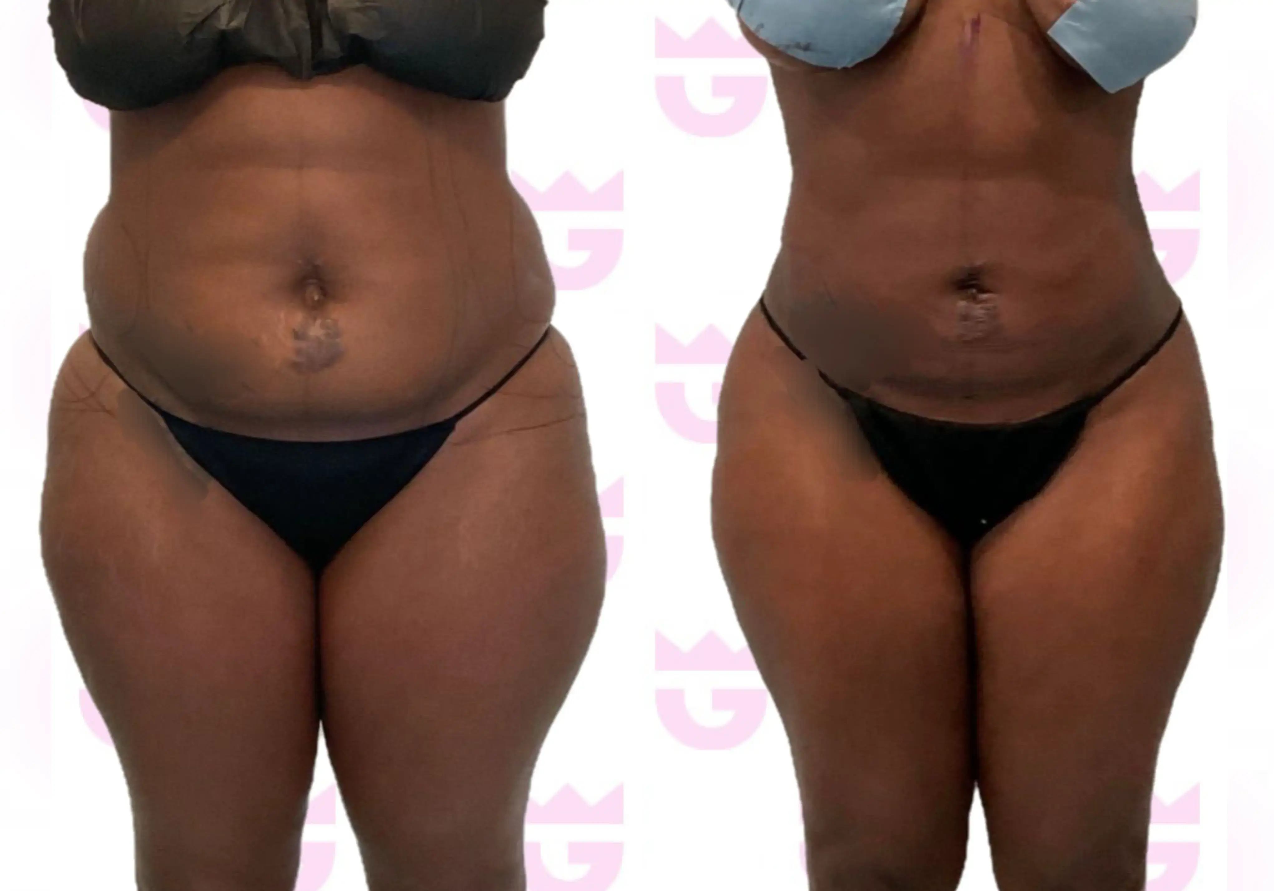 Abdomen Liposuction Gallery