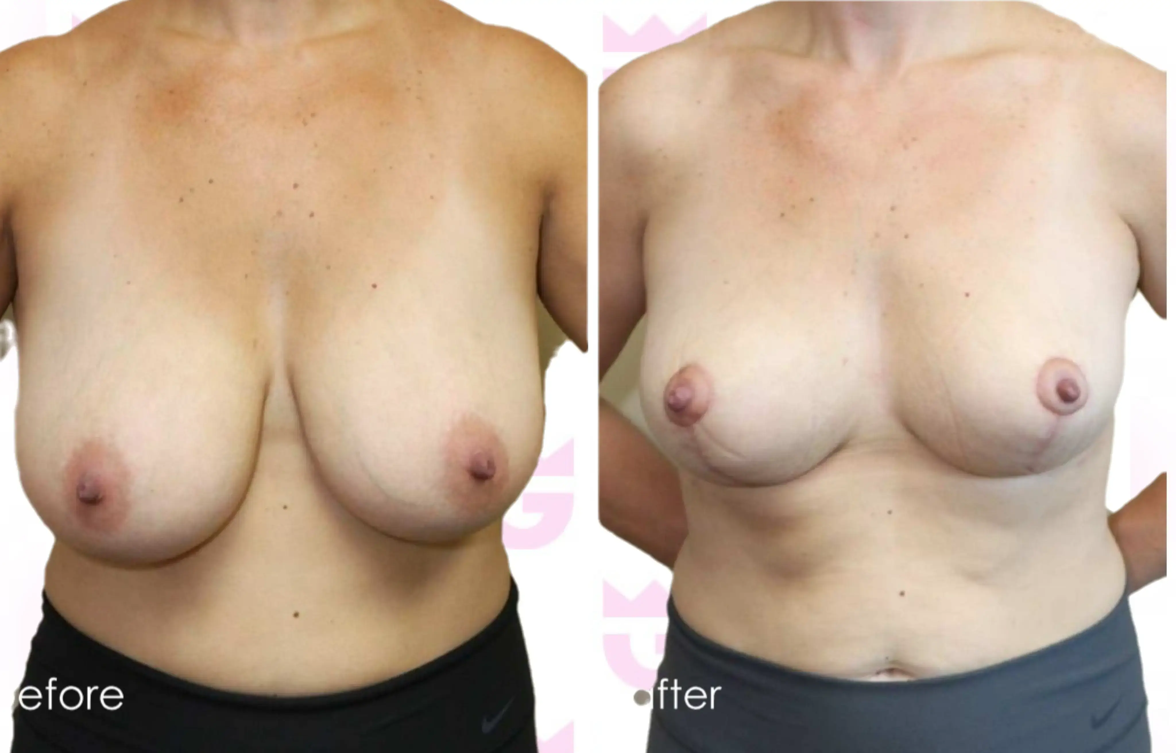 Breast Reduction Gallery