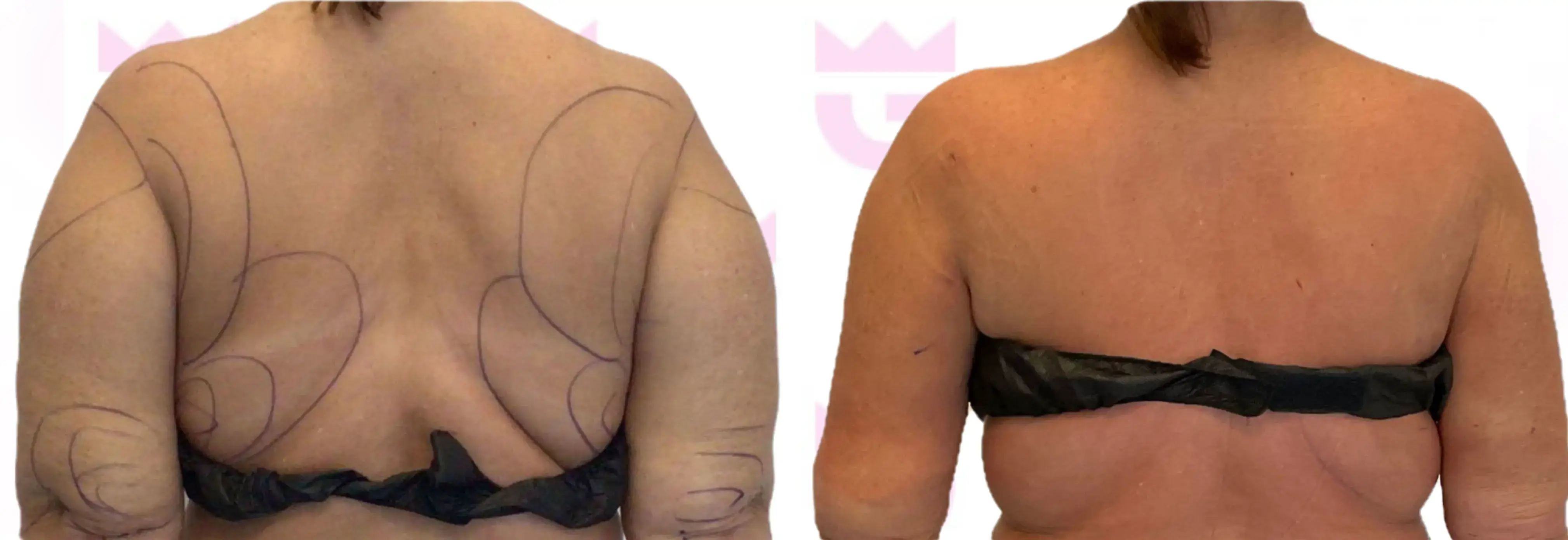 Back Liposuction Gallery