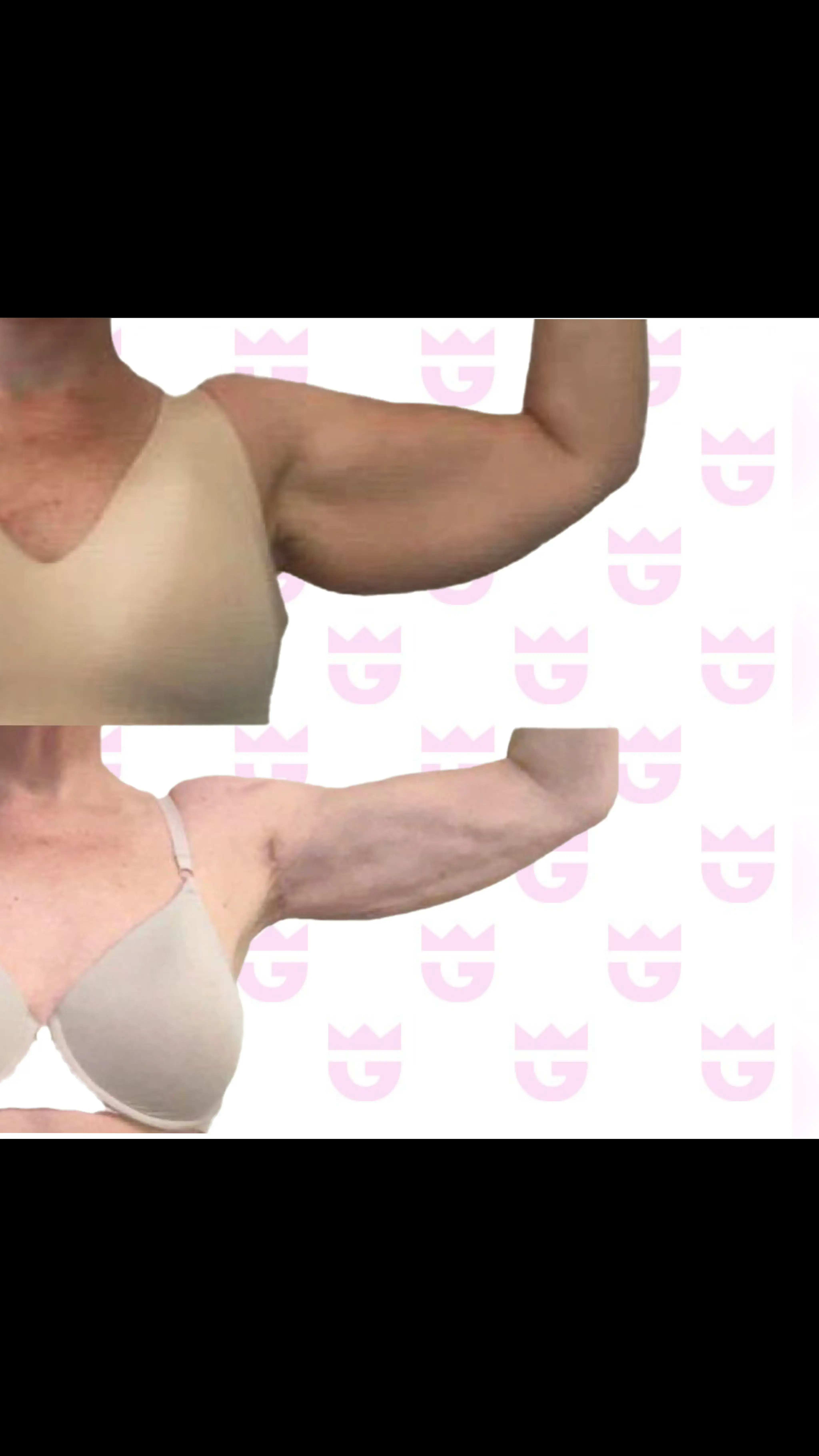 Mini Arm Lift Gallery