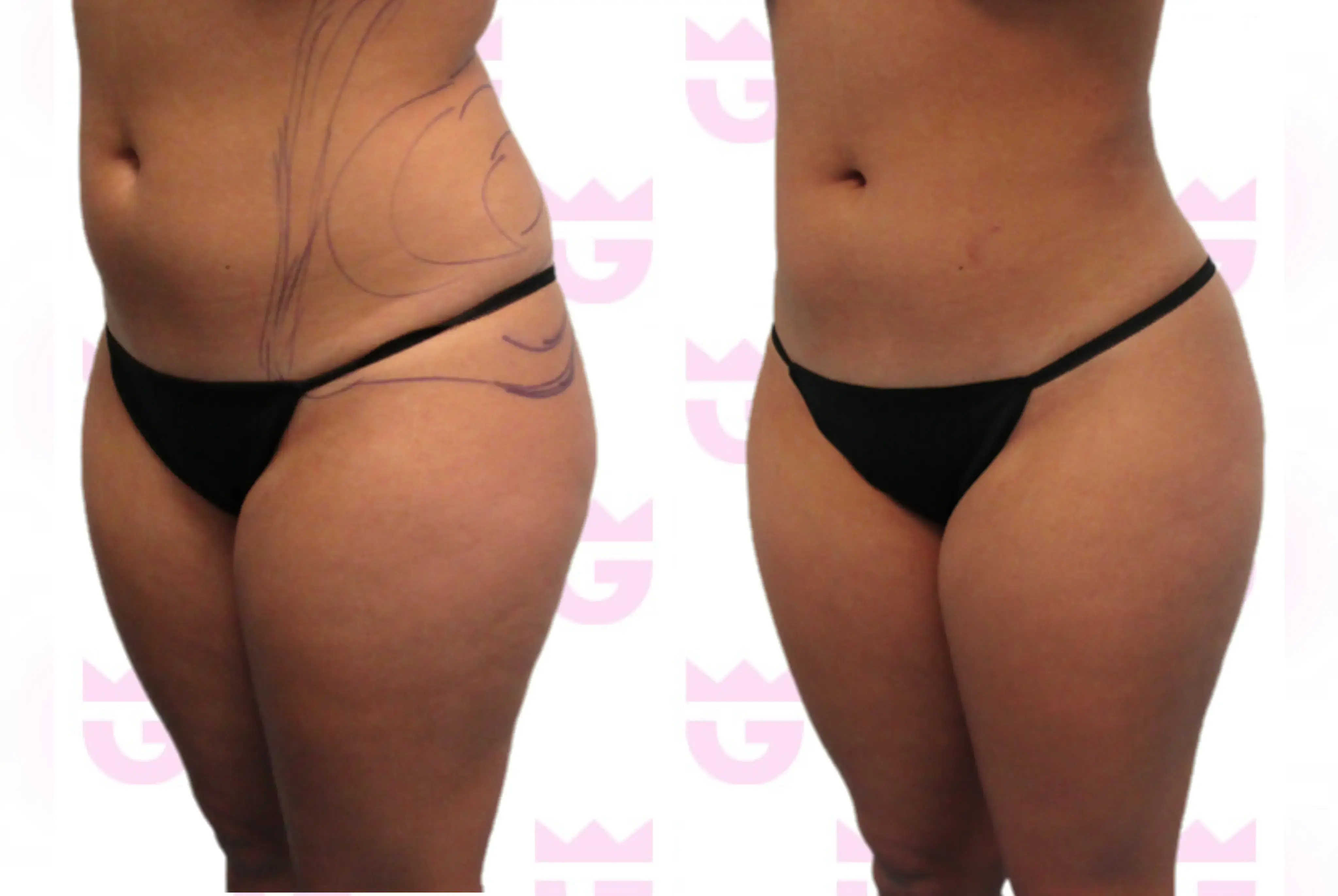Abdomen Liposuction Gallery