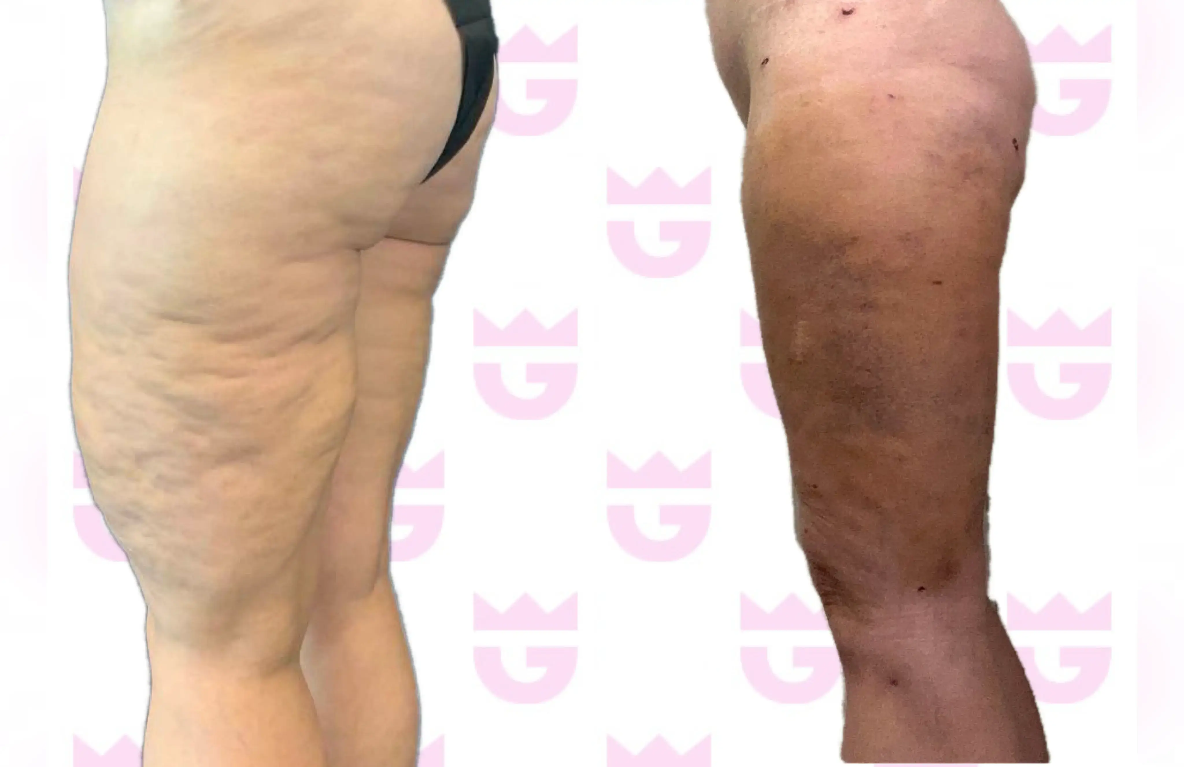 Thigh Lift Gallery