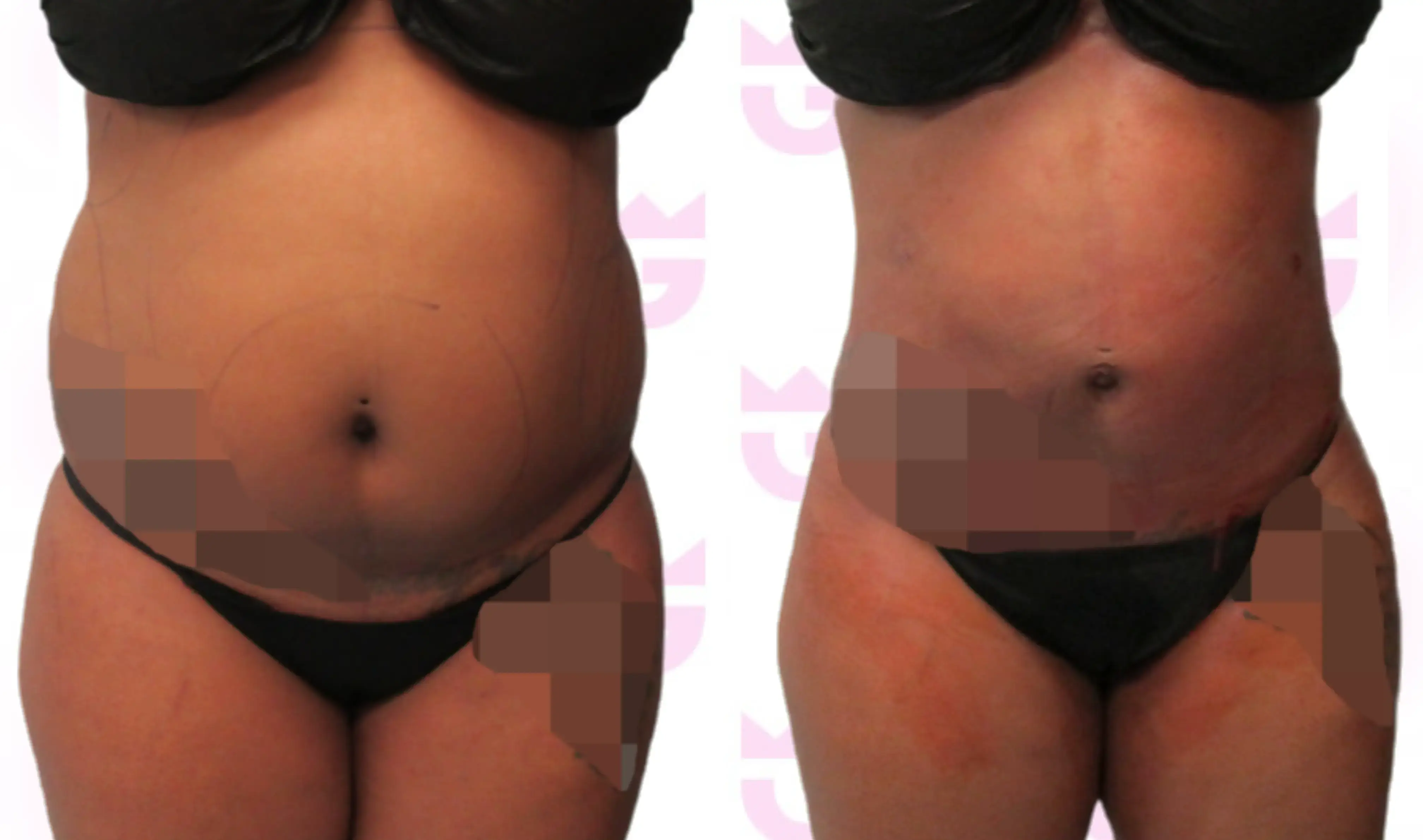 Abdomen Liposuction Gallery
