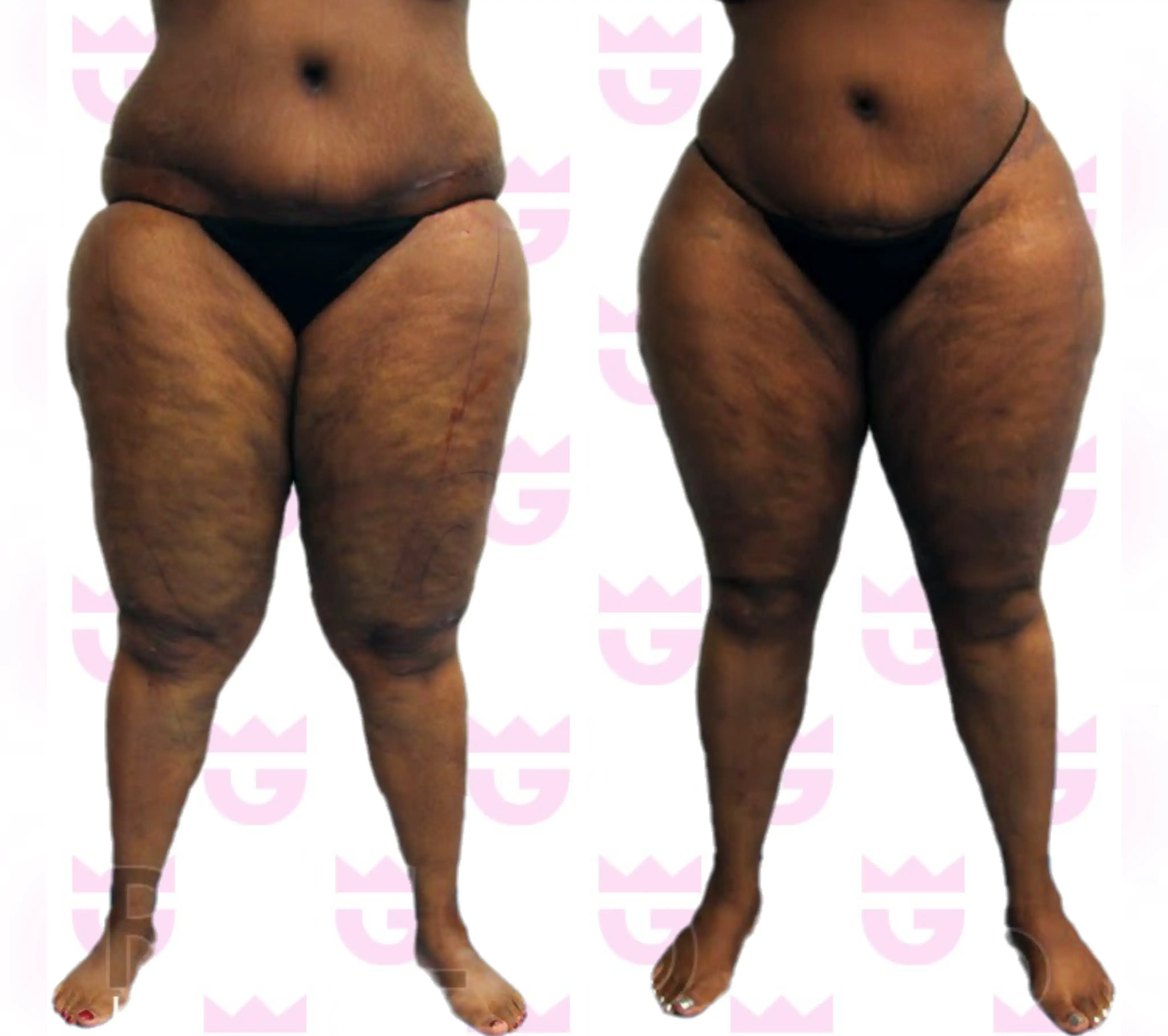 Knee Liposuction Gallery