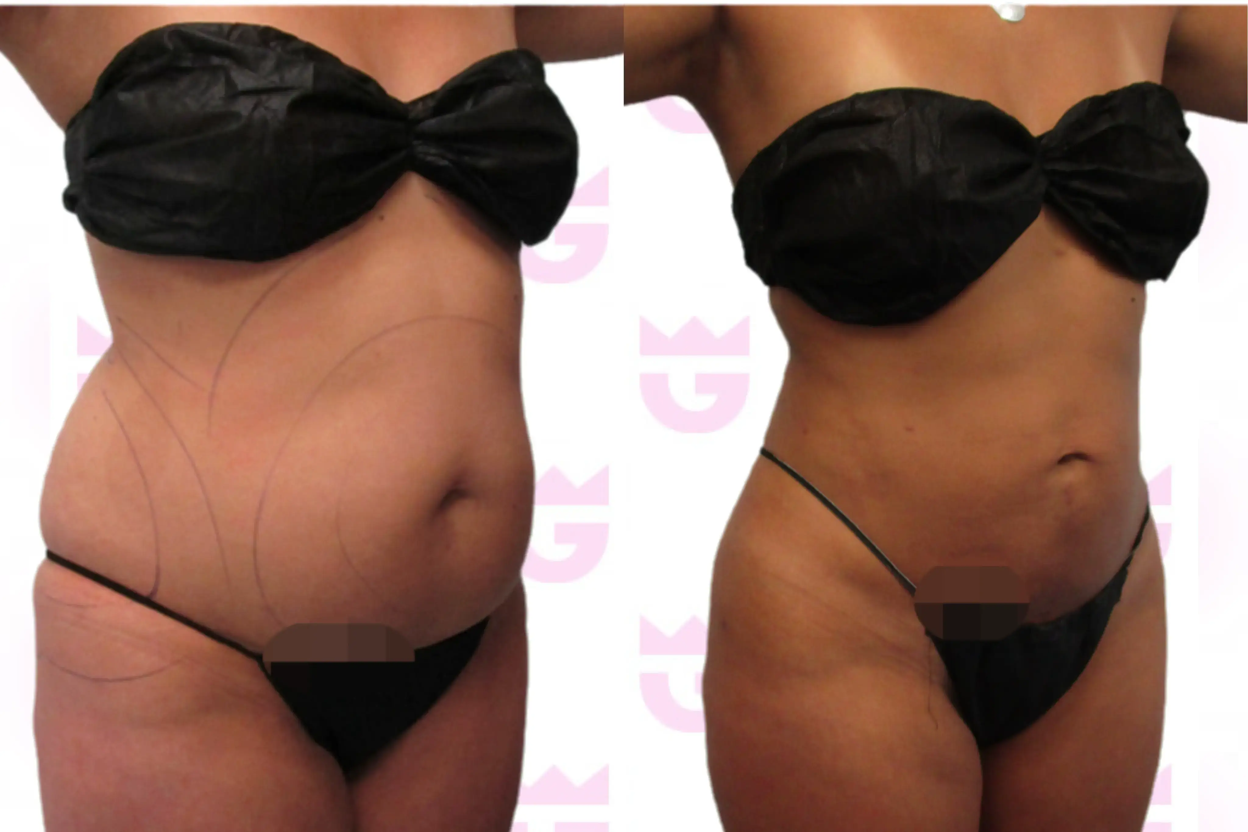 Abdomen Liposuction Gallery