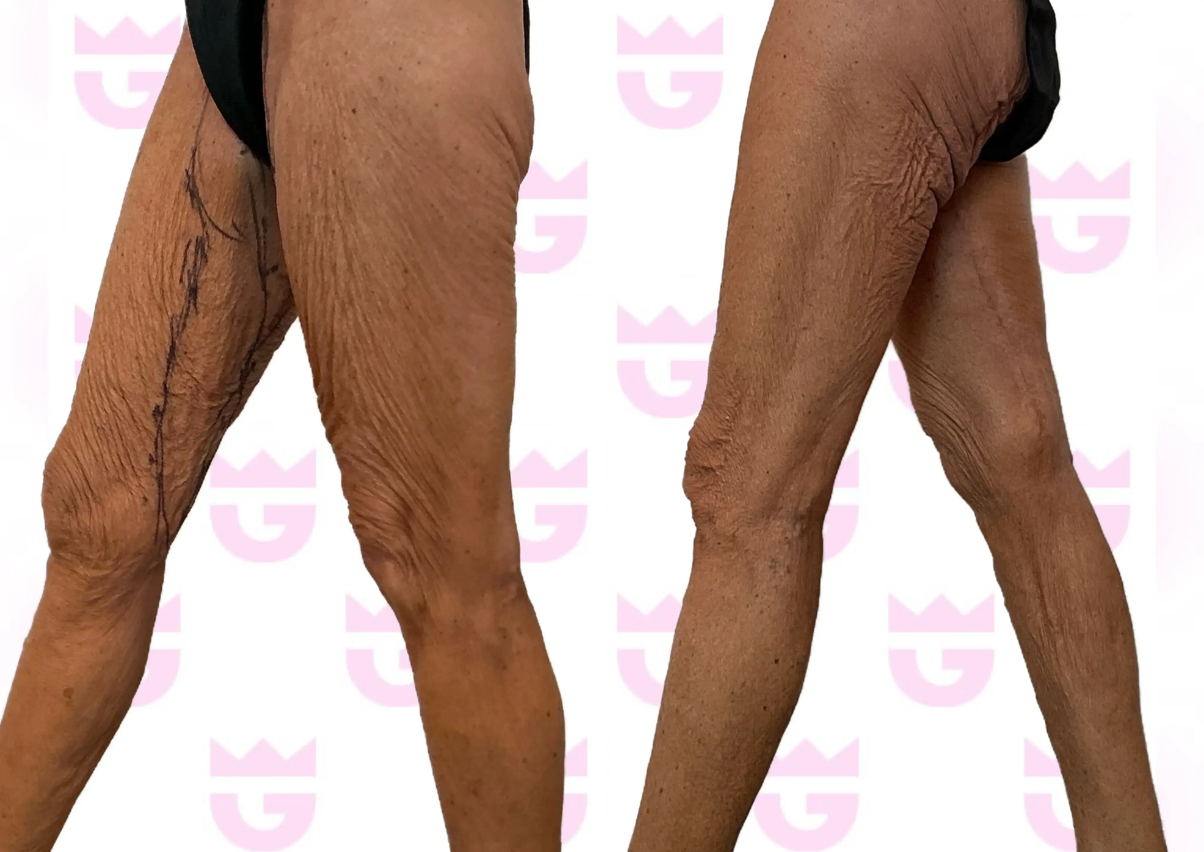 Thigh Lift Gallery