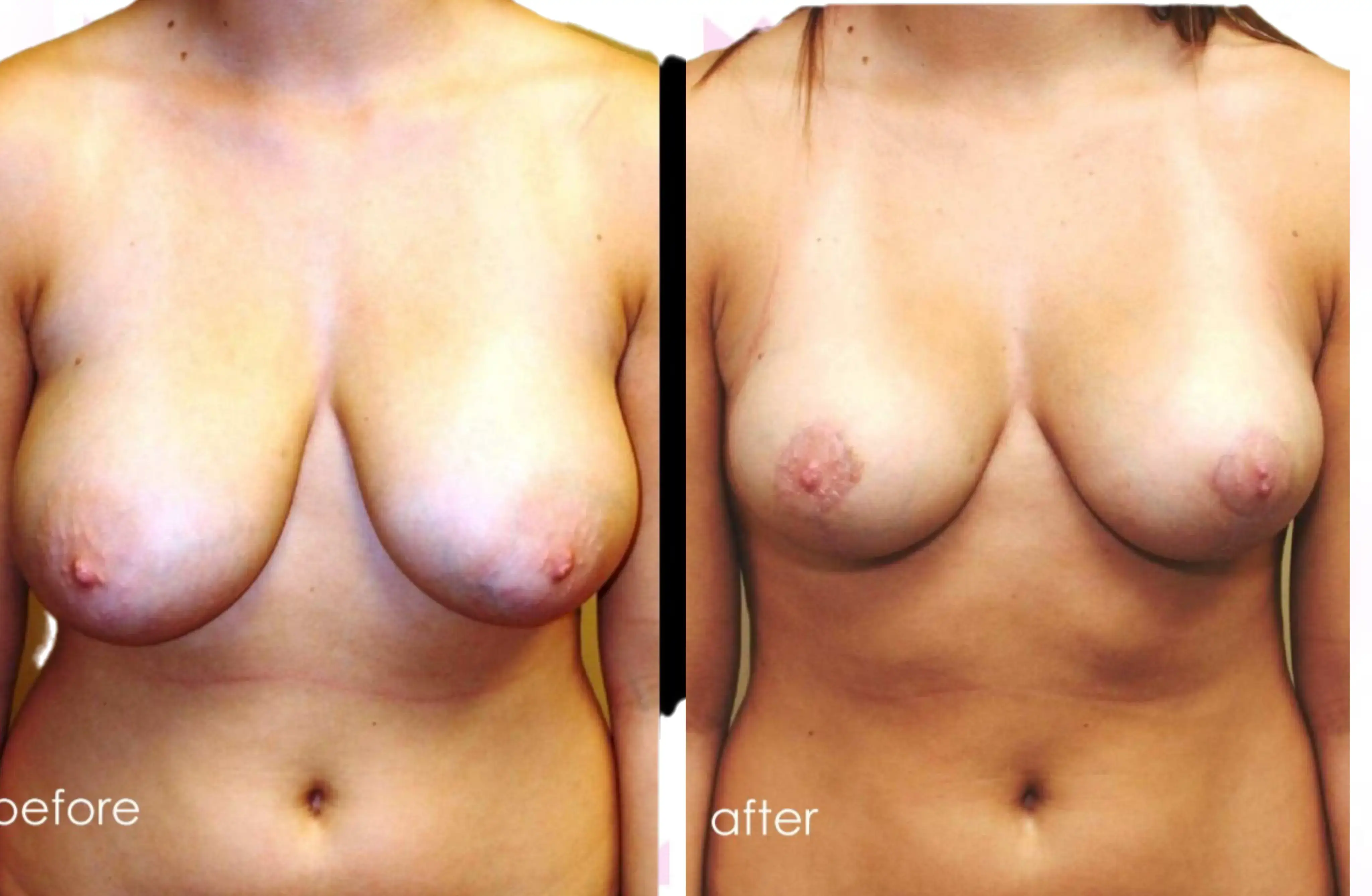 Breast Reduction Gallery