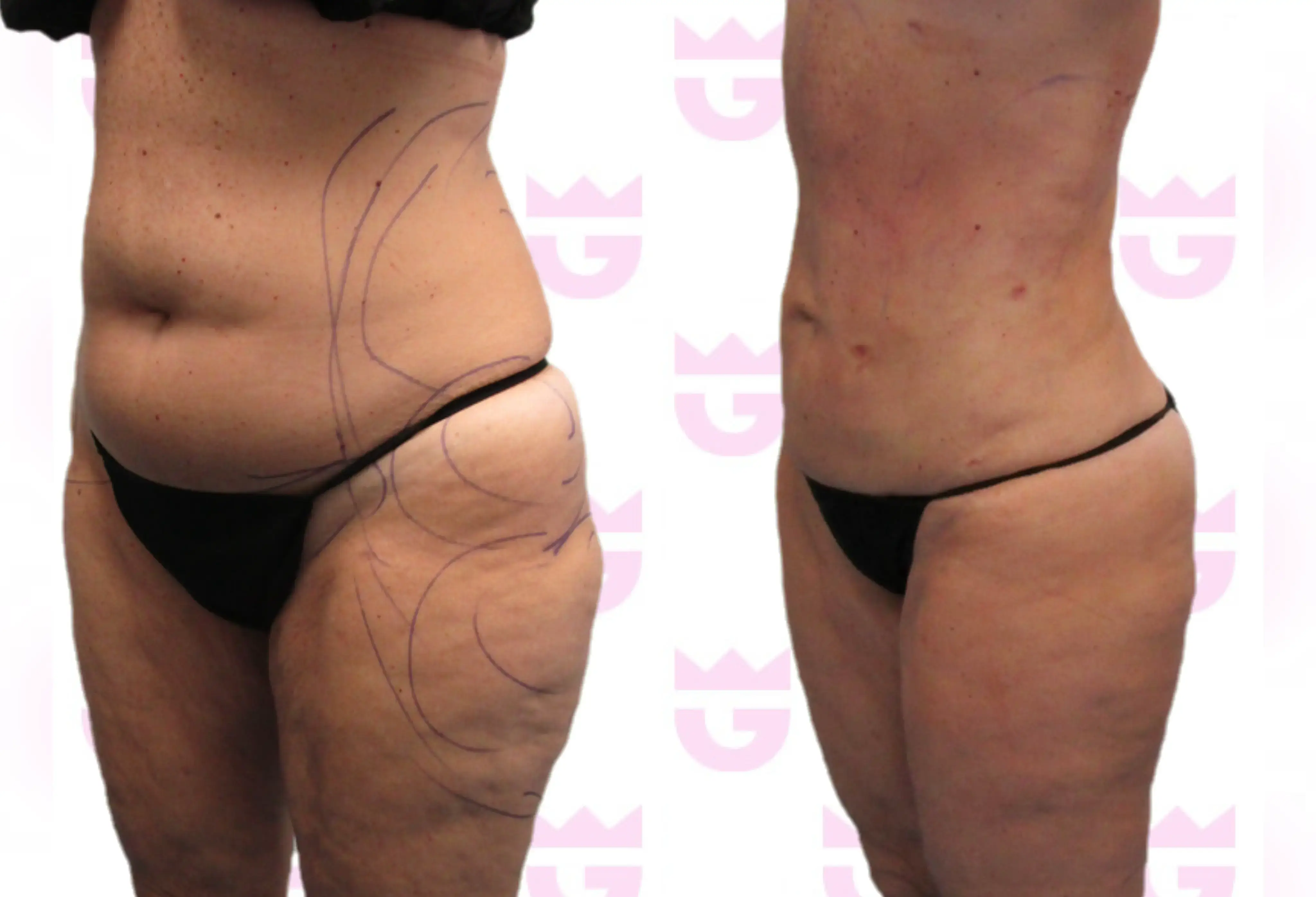 Abdomen Liposuction Gallery
