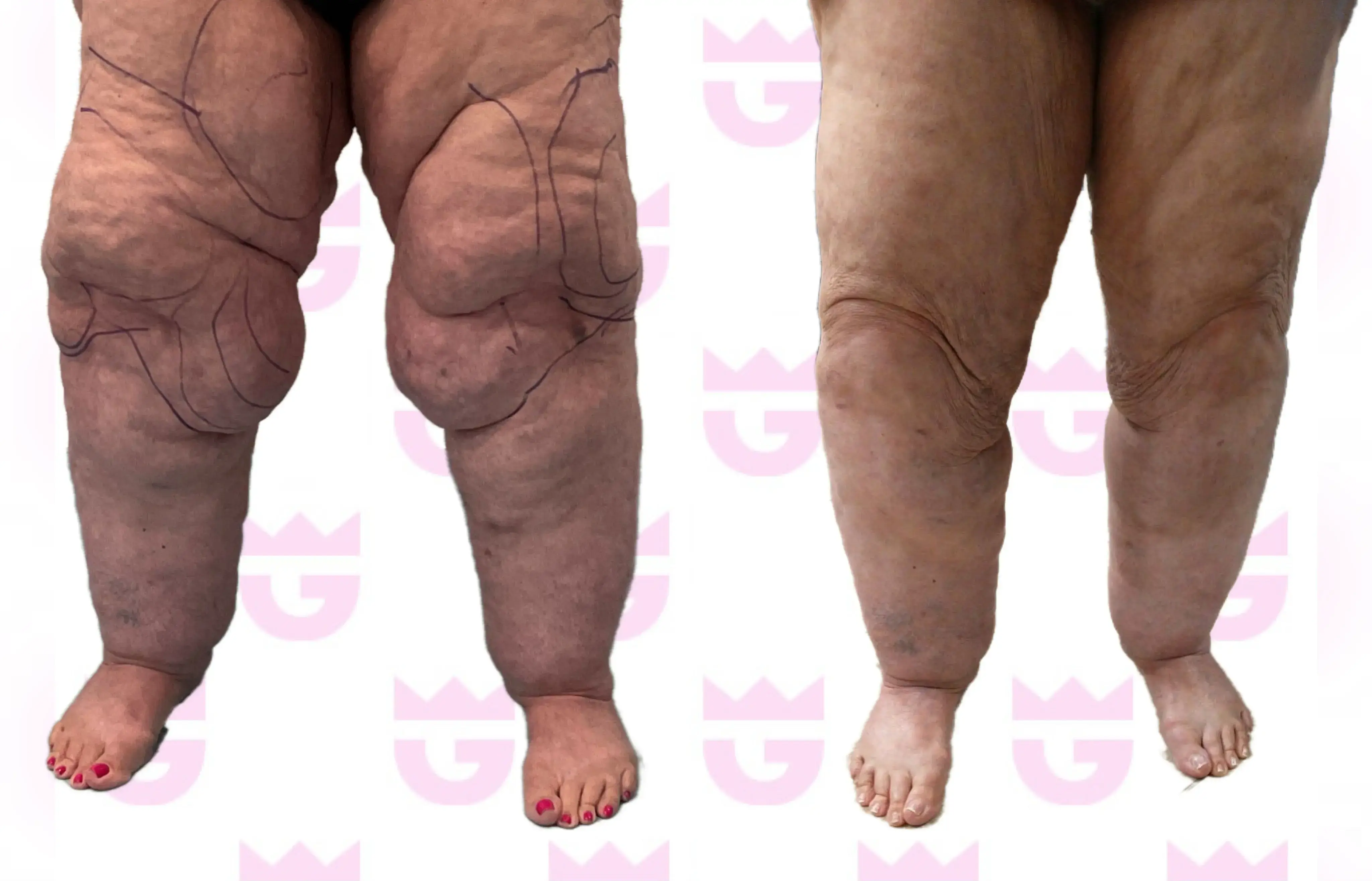 Knee Liposuction Gallery