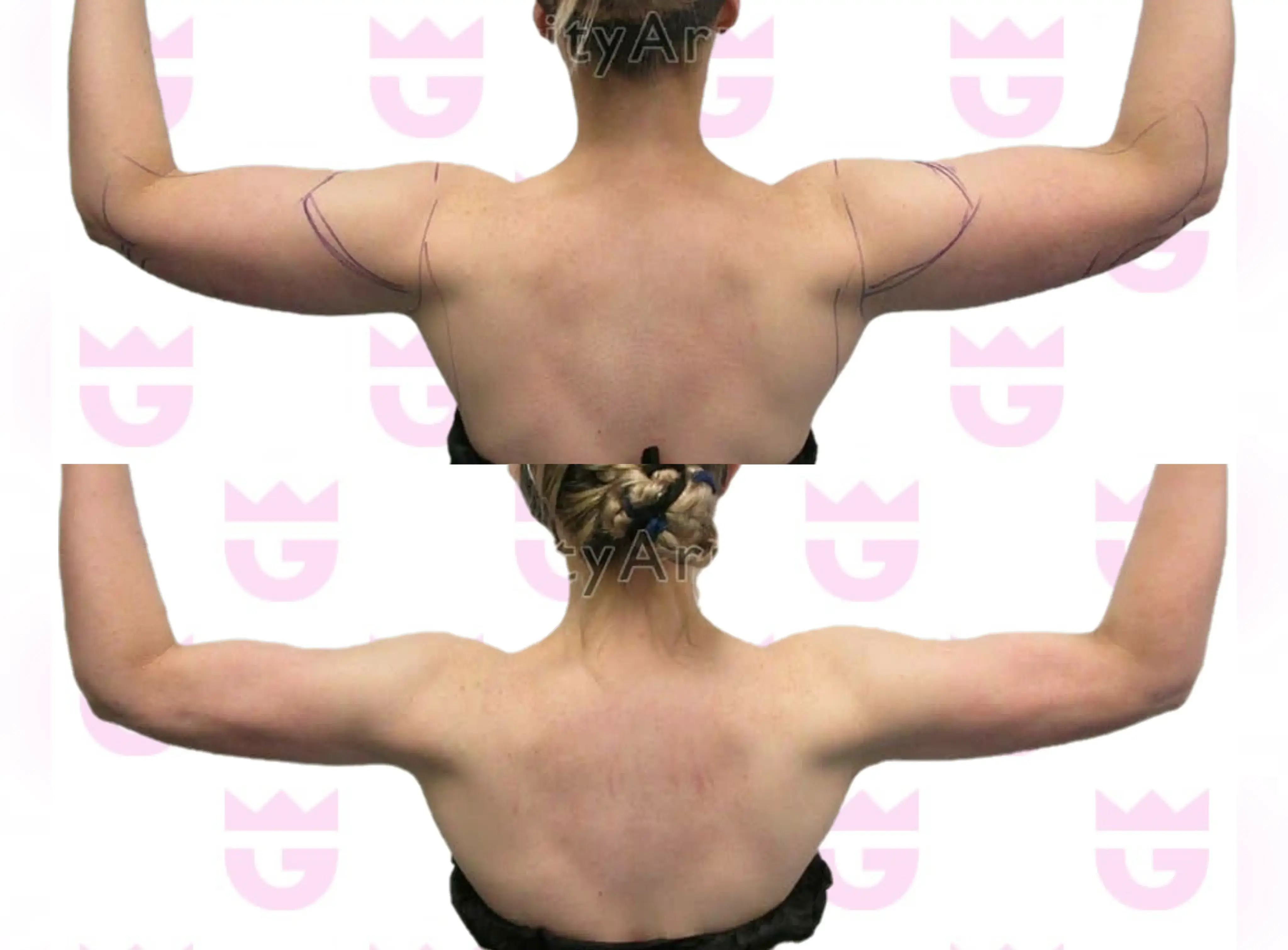 Arm Liposuction Gallery