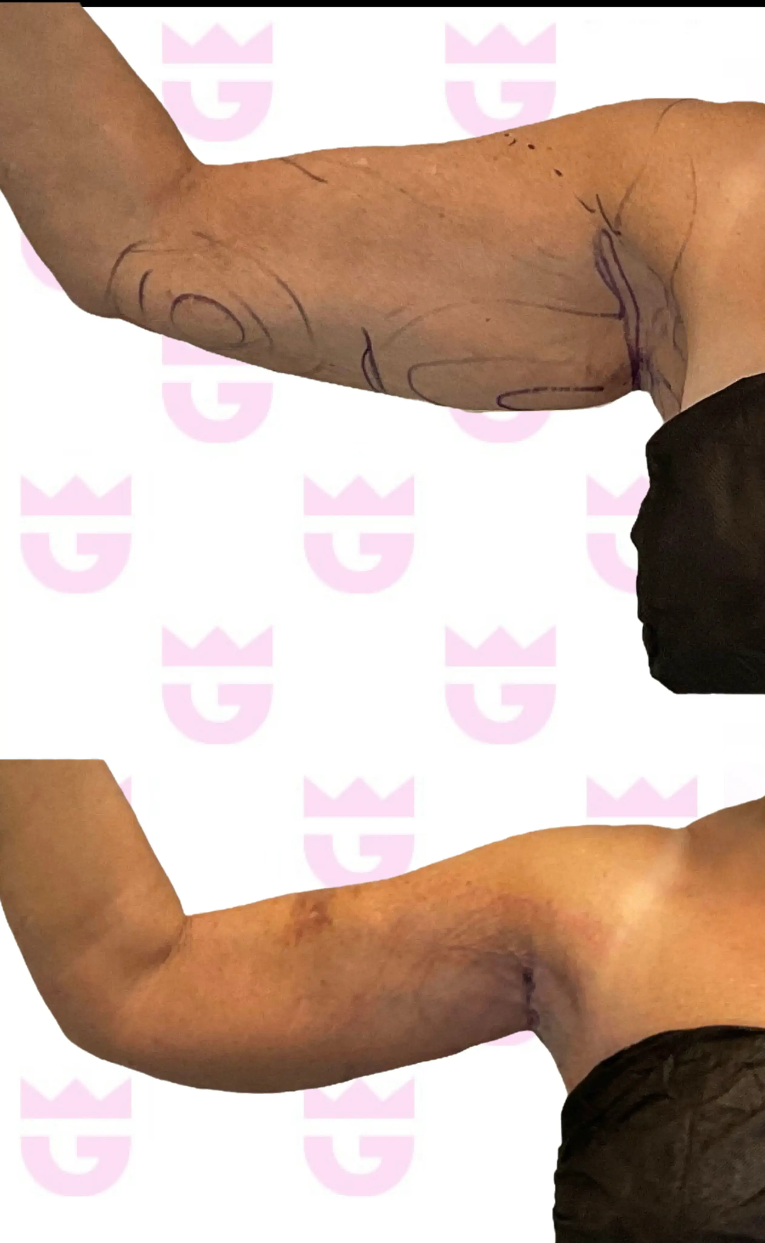 Mini Arm Lift Gallery