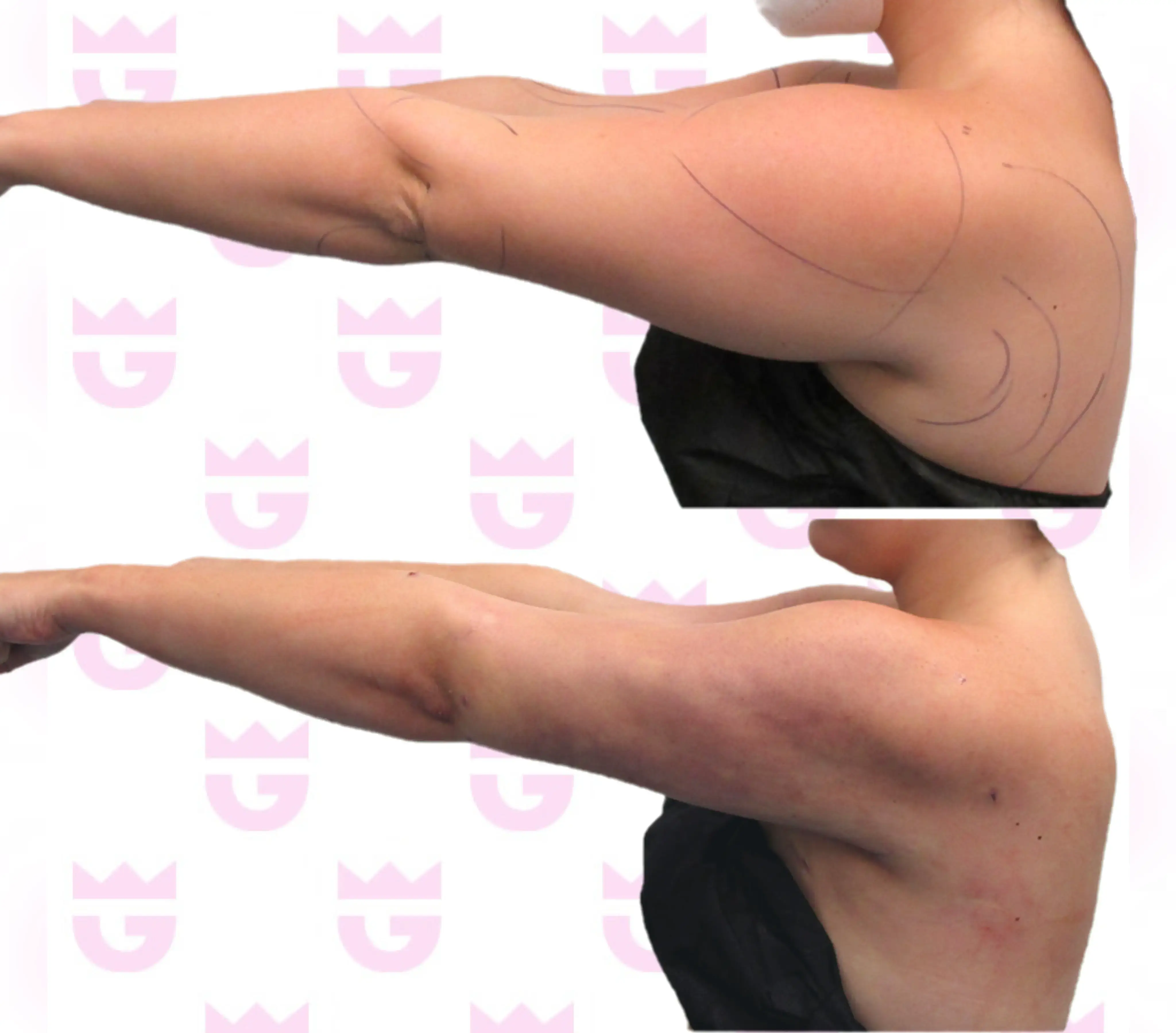 Arm Liposuction Gallery