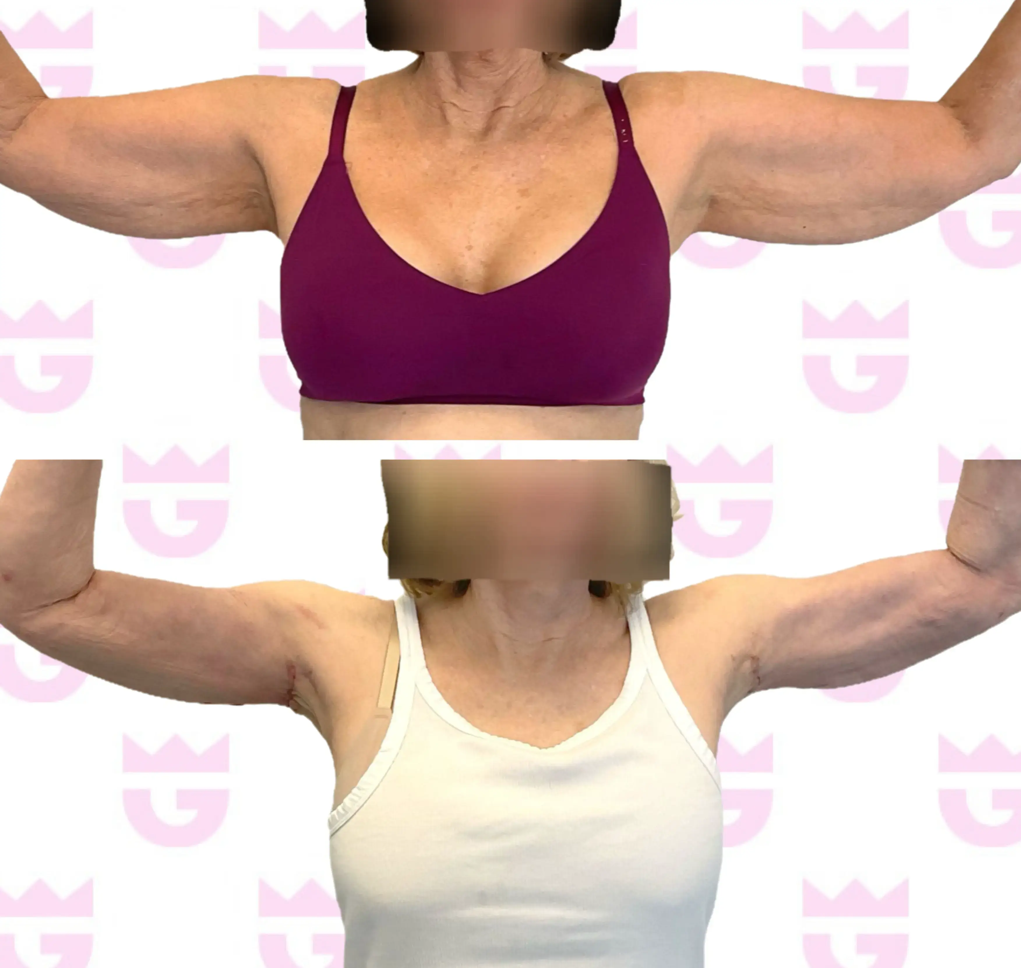 Mini Arm Lift Gallery