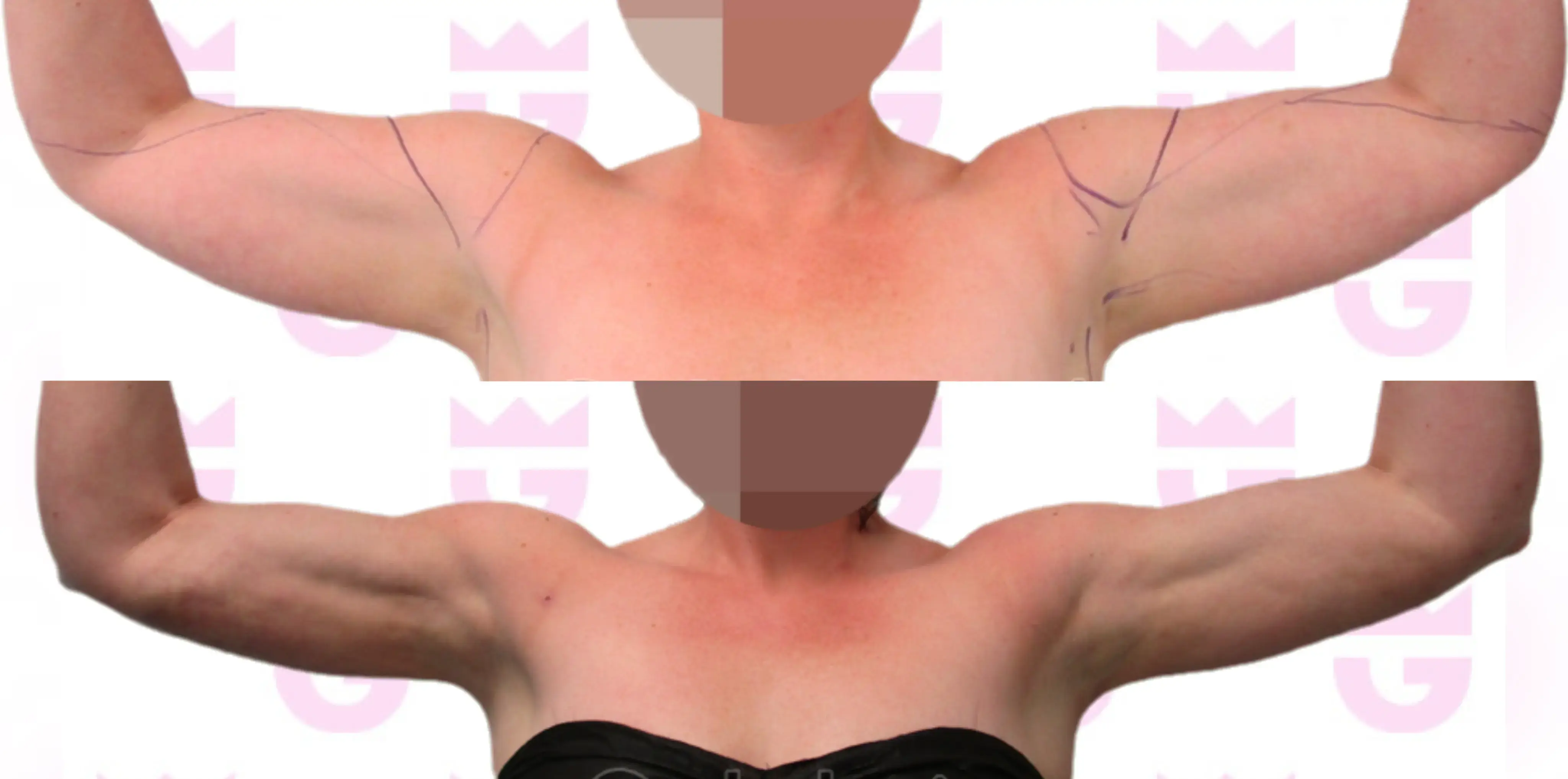 Arm Liposuction Gallery